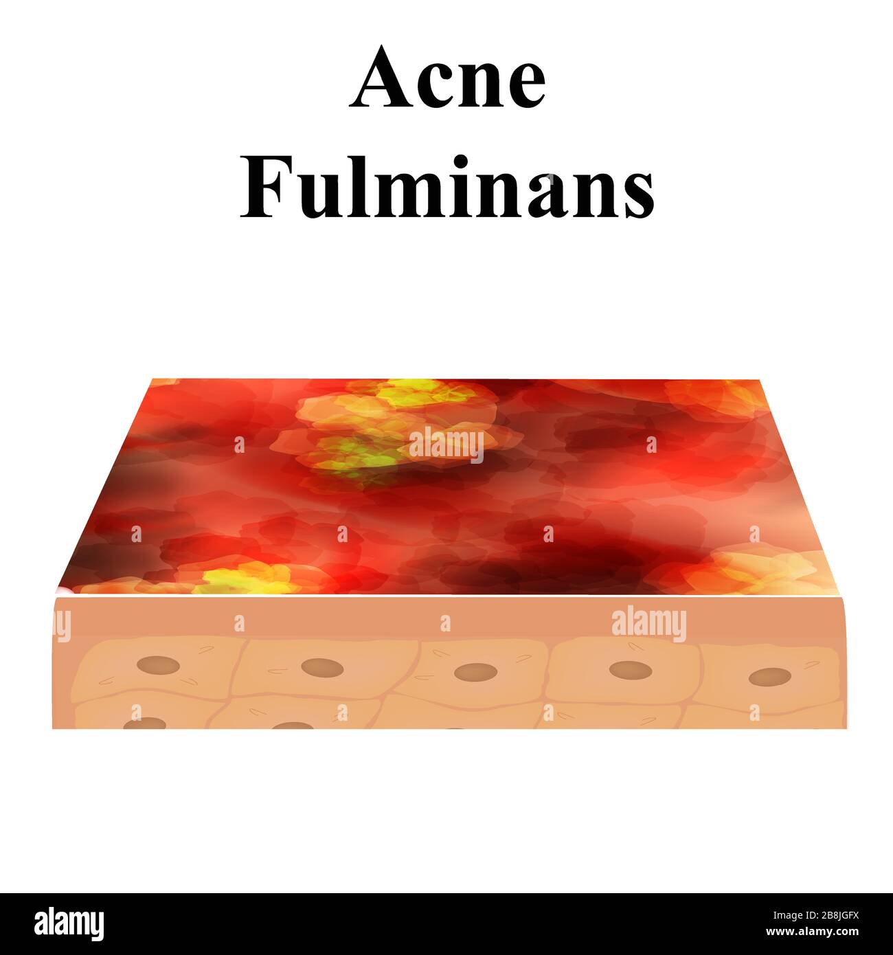 Acné de kyste. furoncle acné sur la peau kystes et boutons. Maladies inflammatoires dermatologiques et cosmétiques sur la peau du visage. Infographies Illustration de Vecteur