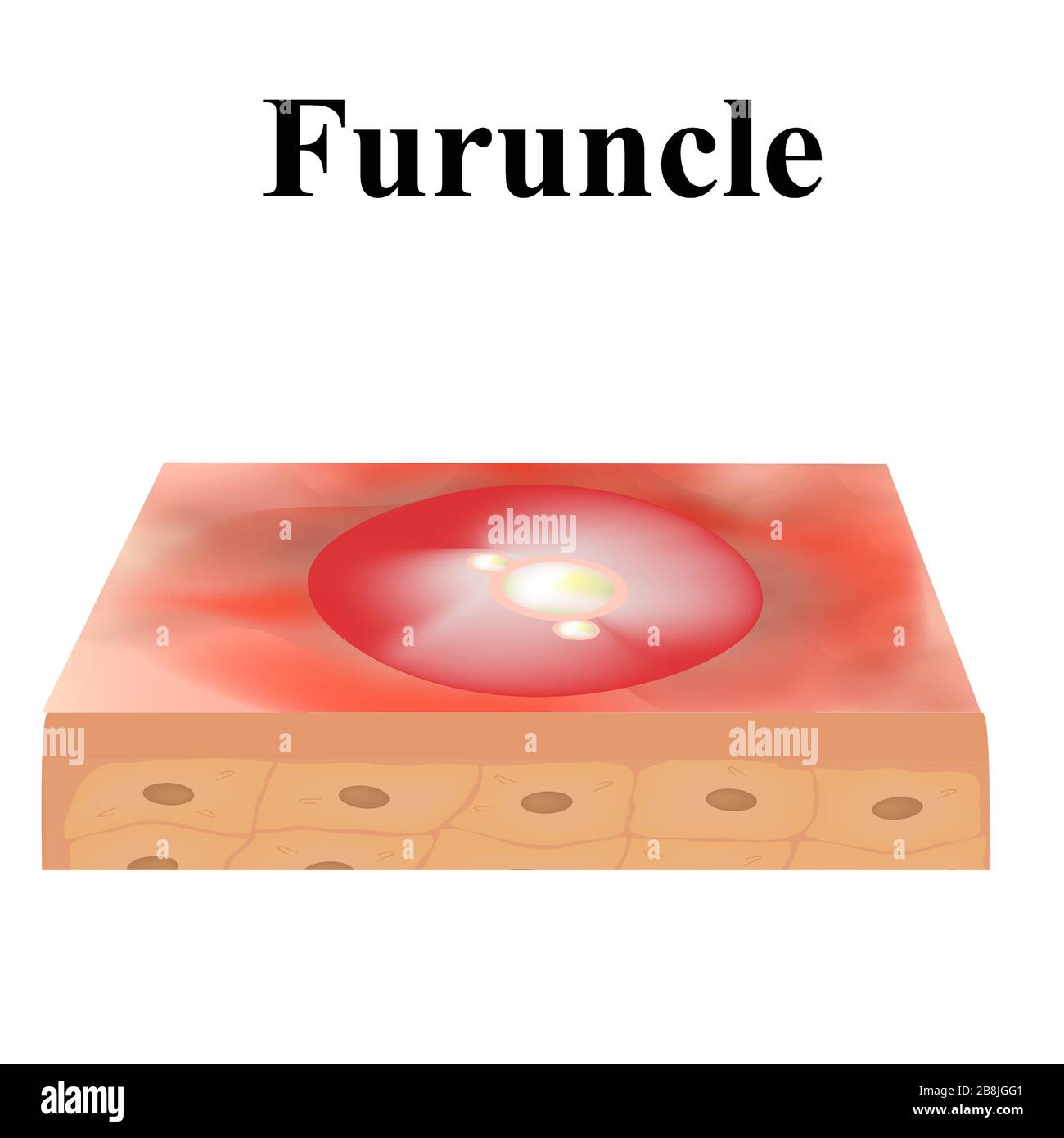 Acné de kyste. furoncle acné sur la peau kystes et boutons. Maladies ...