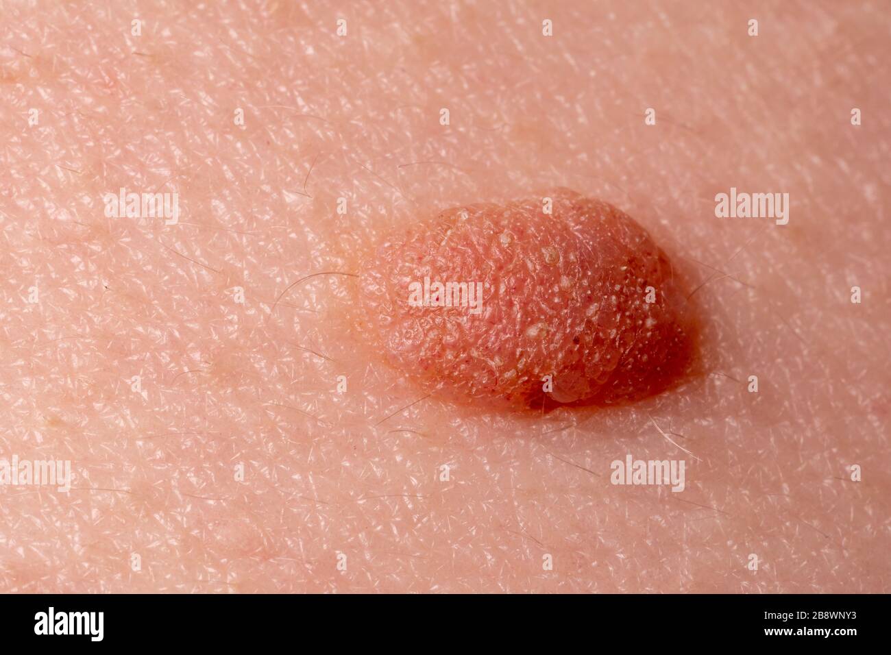 Gros mole gros plan. Photo macro de lésion bénigne de la peau sur la peau caucasienne humaine. Prolifération des cellules de derma pigmentaire, nevus pigmenté mélanocytaire Banque D'Images