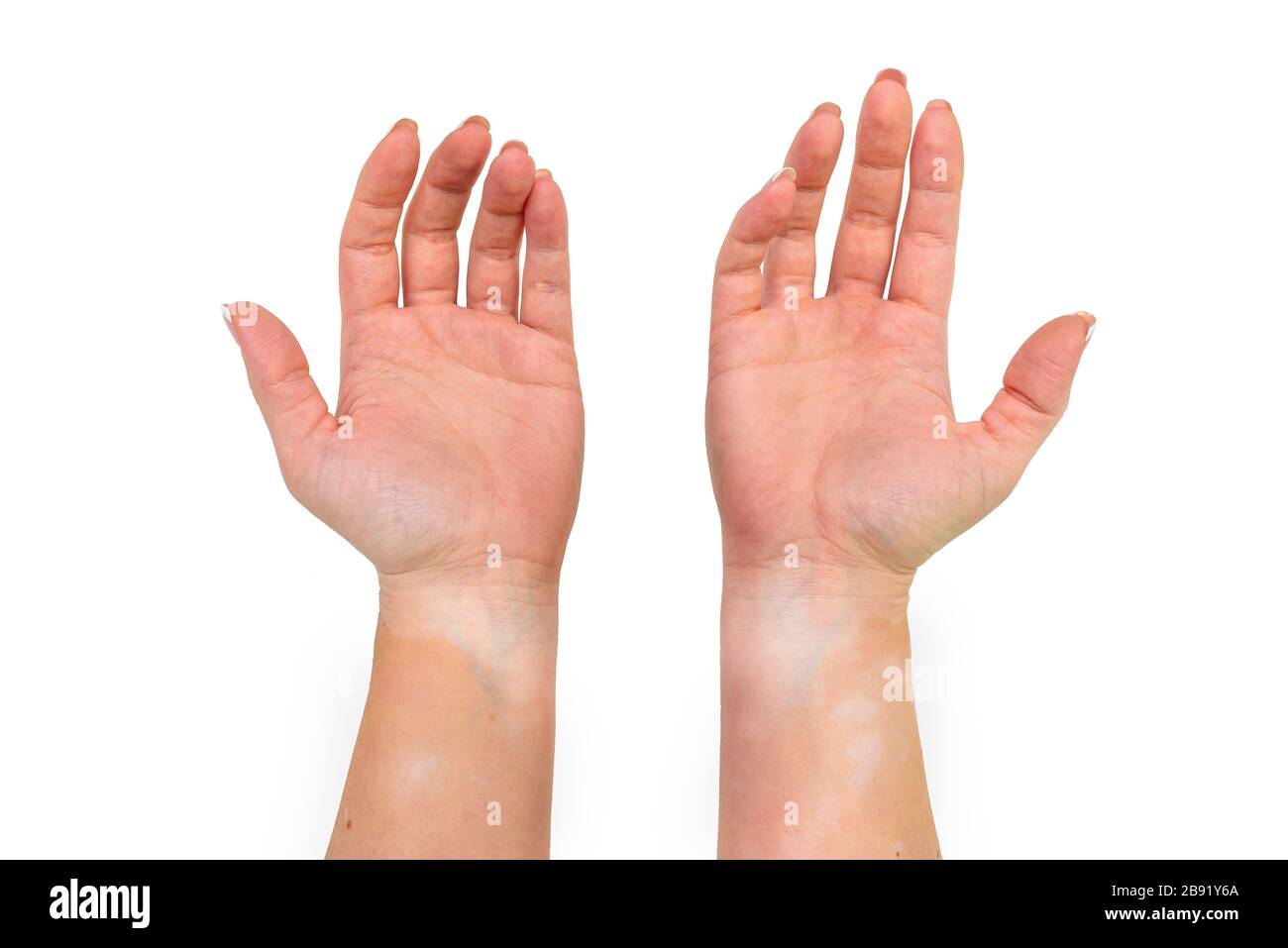 Taches de la maladie de vitiligo à l'intérieur des mains et des avant-bras d'une jeune femme caucasienne, isolée sur un fond blanc avec un chemin de coupure. Banque D'Images