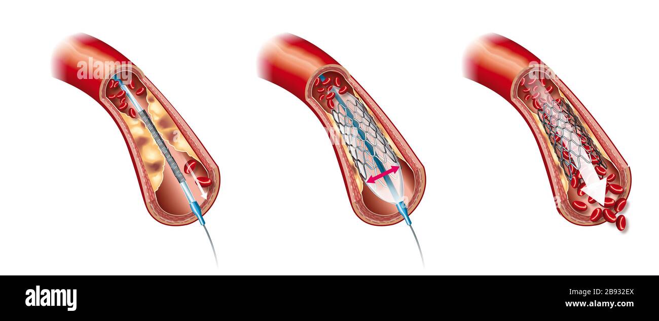 Illustration médicale montrant l'angioplastie du ballonnet et l'insertion du stent Banque D'Images