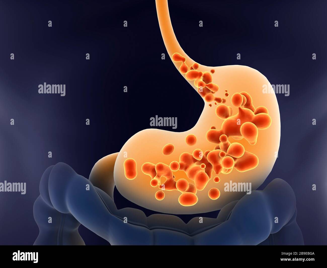 Illustration médicale du reflux acide dans l'estomac humain. Banque D'Images