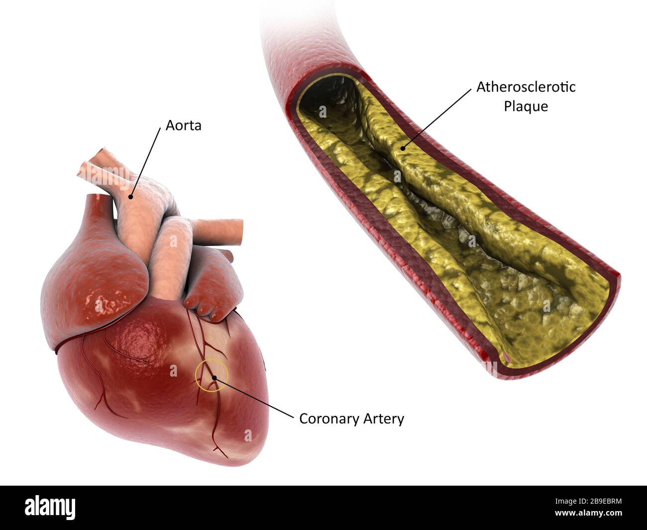 Plaque athérosclérotique dans l'artère, menant à une crise cardiaque. Banque D'Images