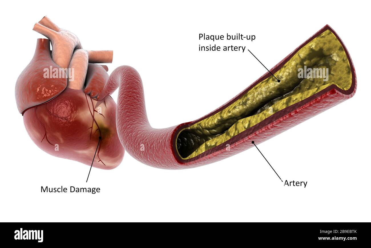 Illustration médicale de l'accumulation de plaque dans l'artère, conduisant à une crise cardiaque. Banque D'Images
