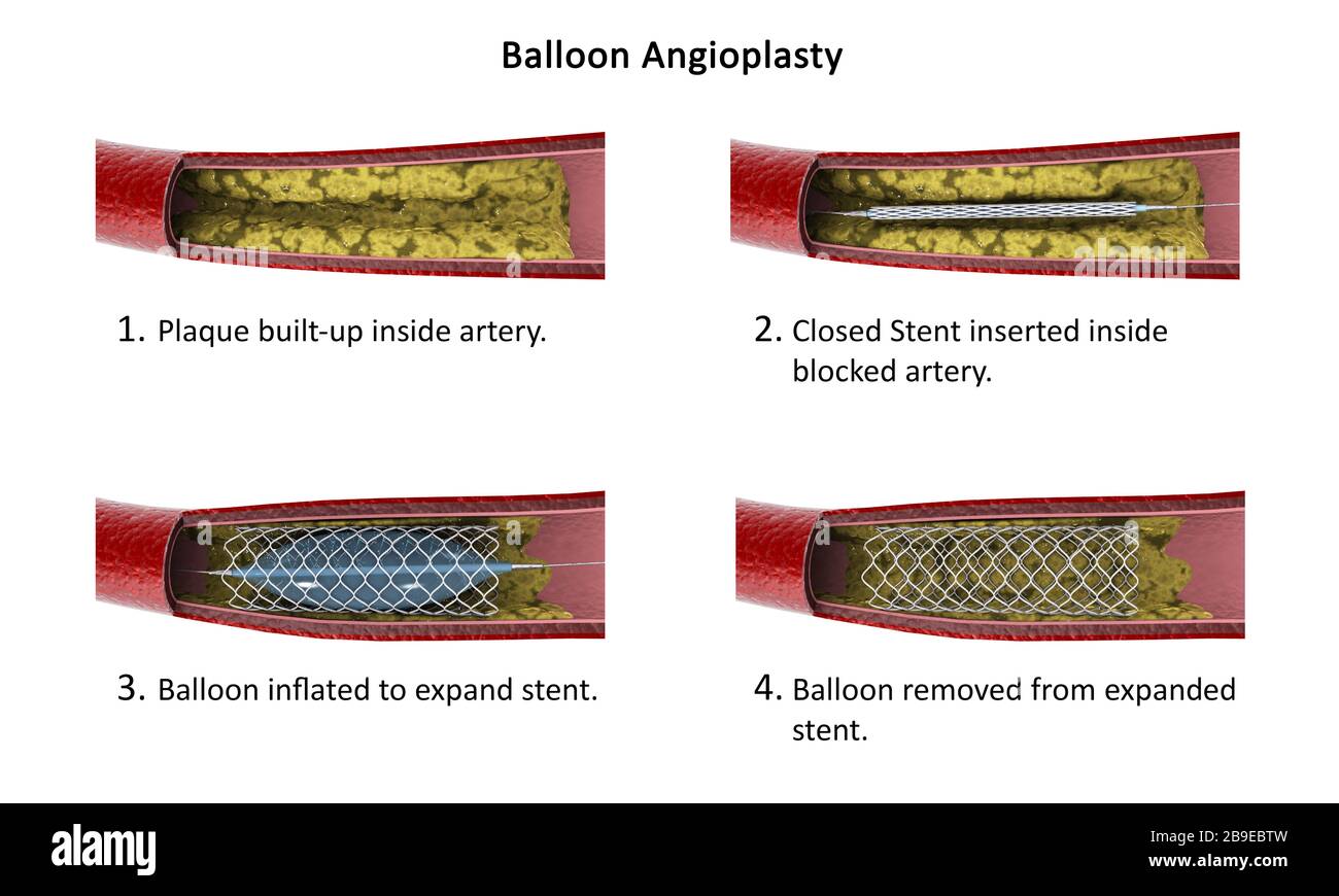 Diagramme montrant la procédure d'angioplastie du ballonnet. Banque D'Images