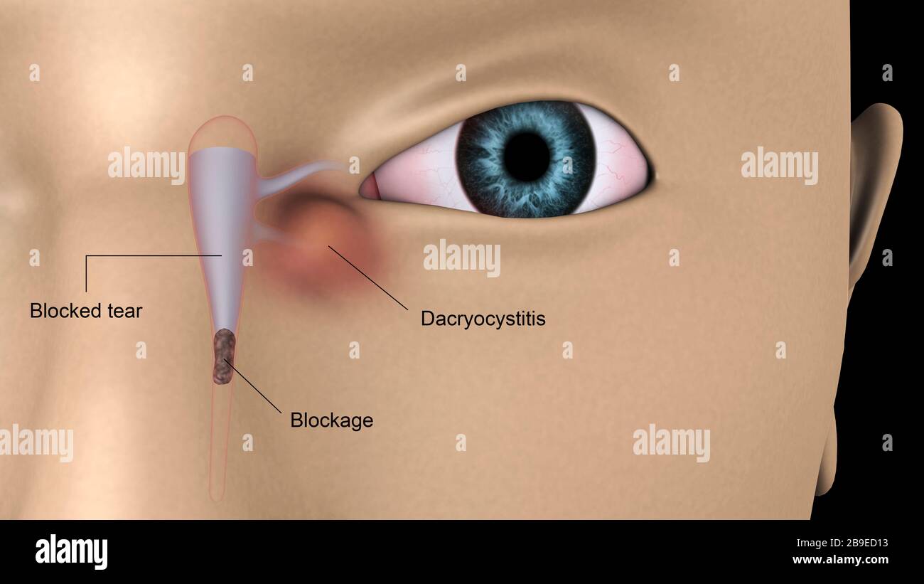 Illustration médicale de la dacryocystite dans l'œil humain. Banque D'Images