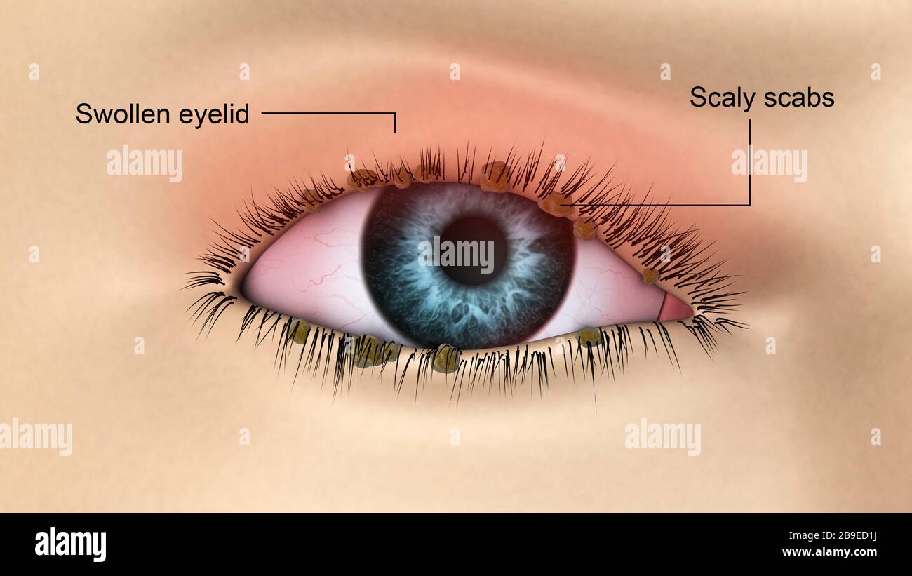 Illustration médicale de la blépharitis dans l'œil humain. Banque D'Images