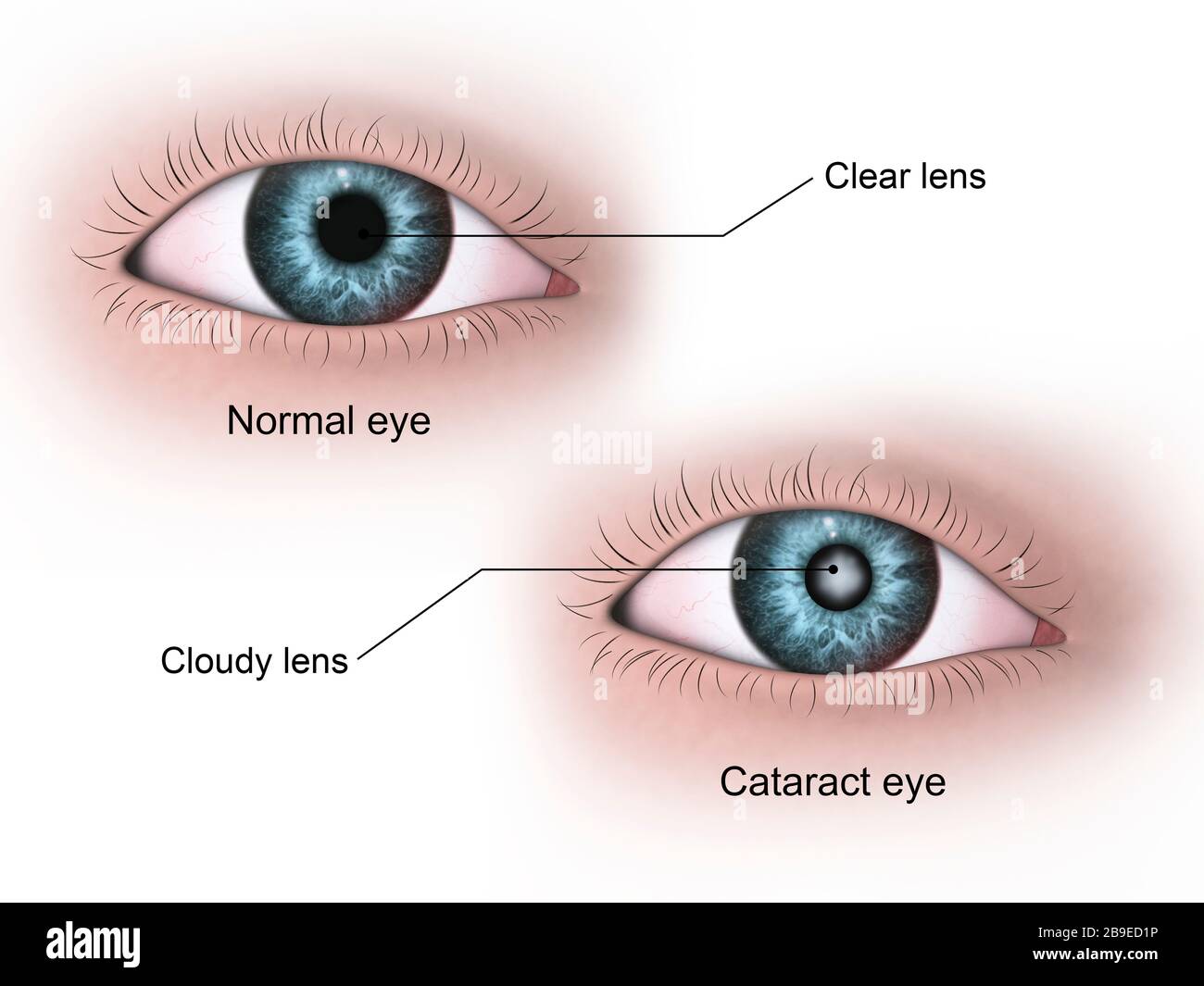 Illustration médicale d'une cataracte dans l'œil humain, par rapport à un œil normal. Banque D'Images