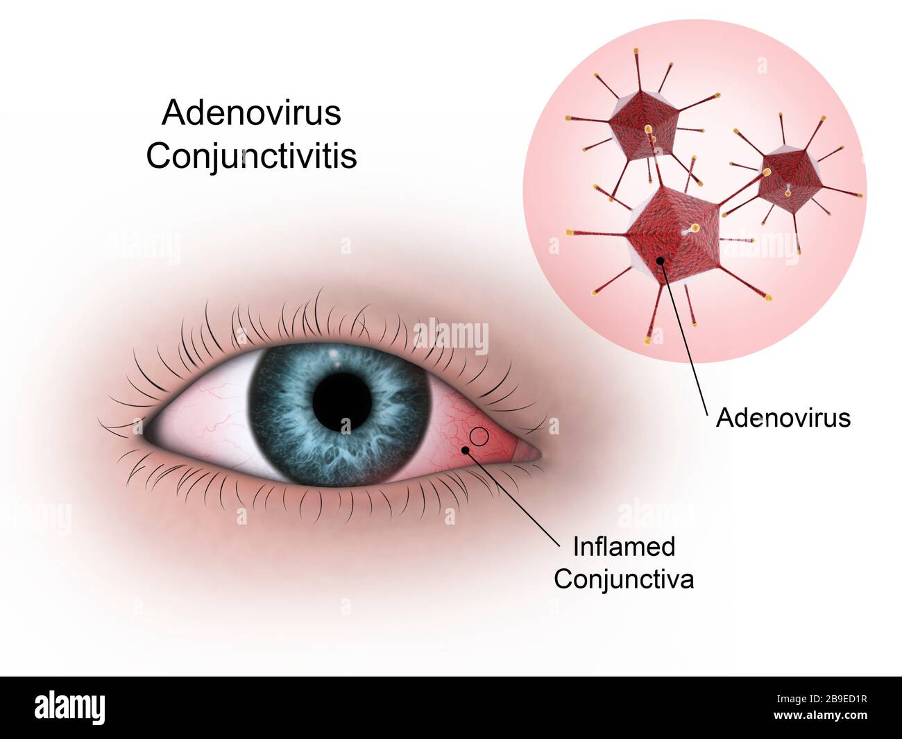 Conjonctivite virale dans l'œil, causée par l'adénovirus. Banque D'Images