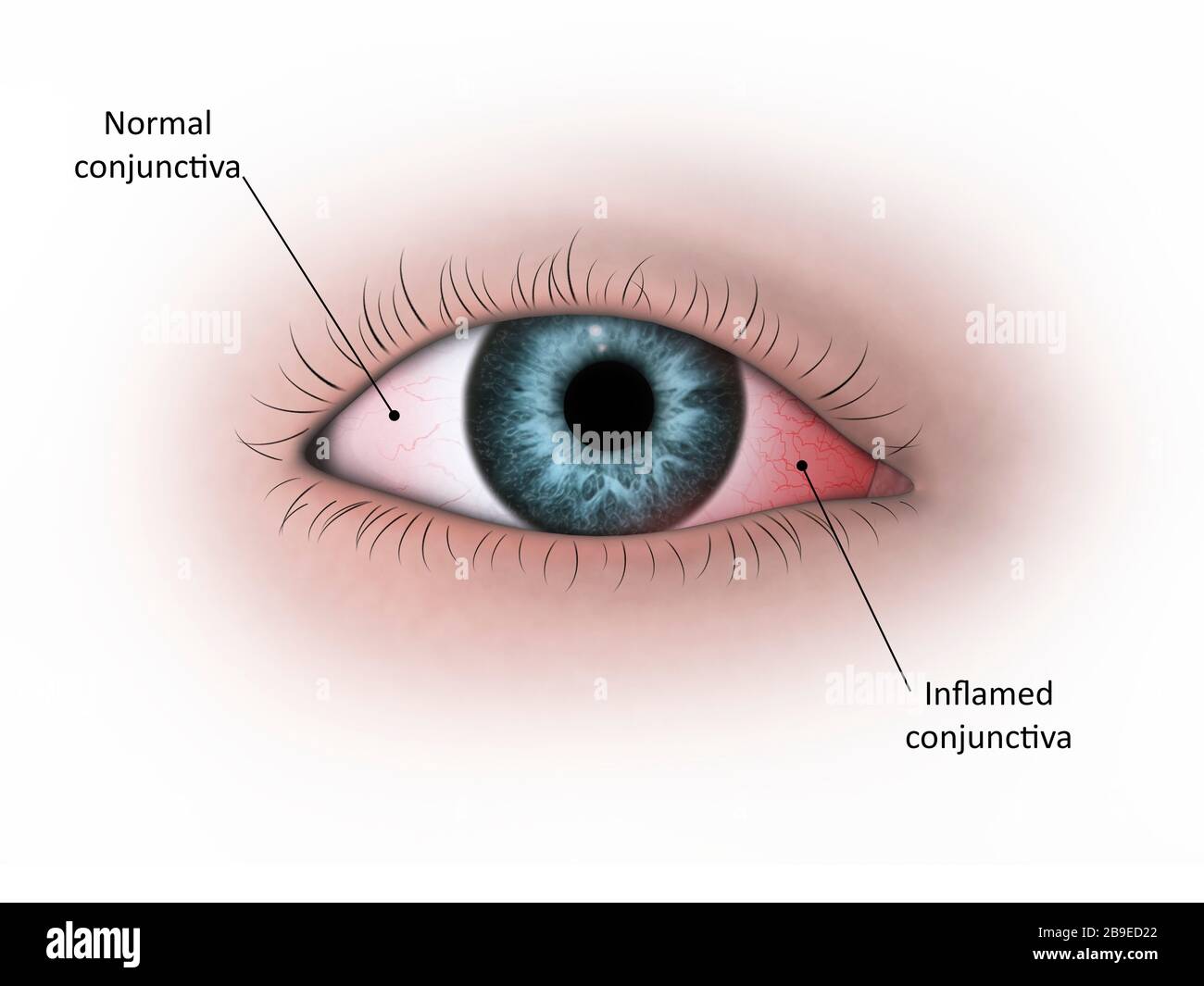 Illustration médicale de la conjonctivite dans l'œil humain. Banque D'Images