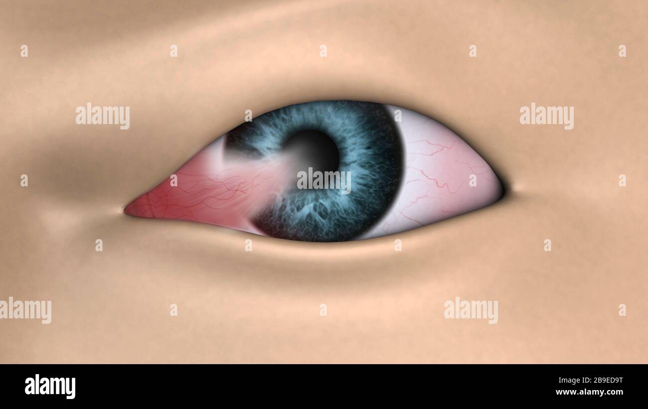 Illustration médicale montrant le ptérygium dans l'œil humain. Banque D'Images