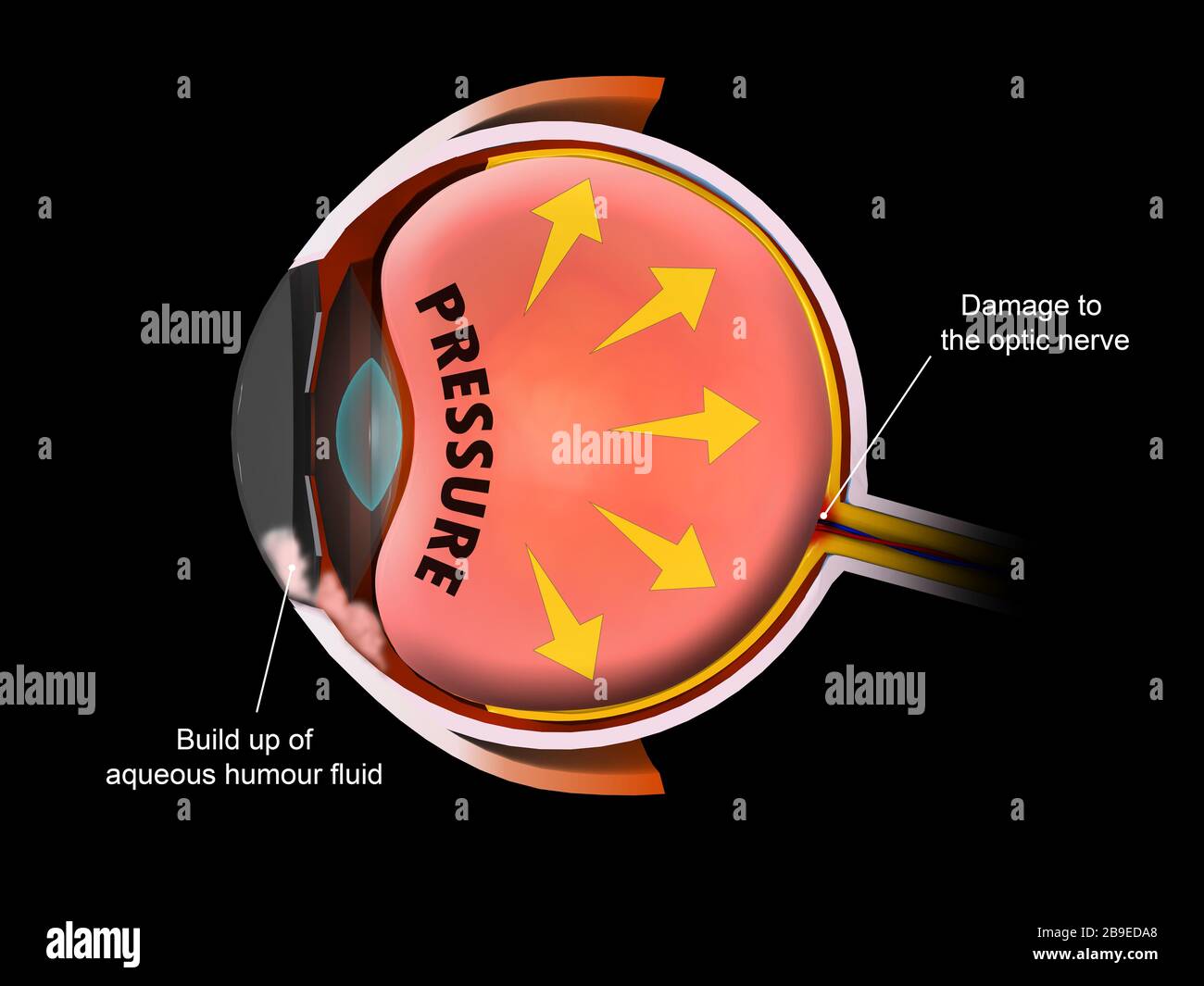 Illustration médicale montrant une pression accrue dans le globe oculaire, conduisant au glaucome. Banque D'Images