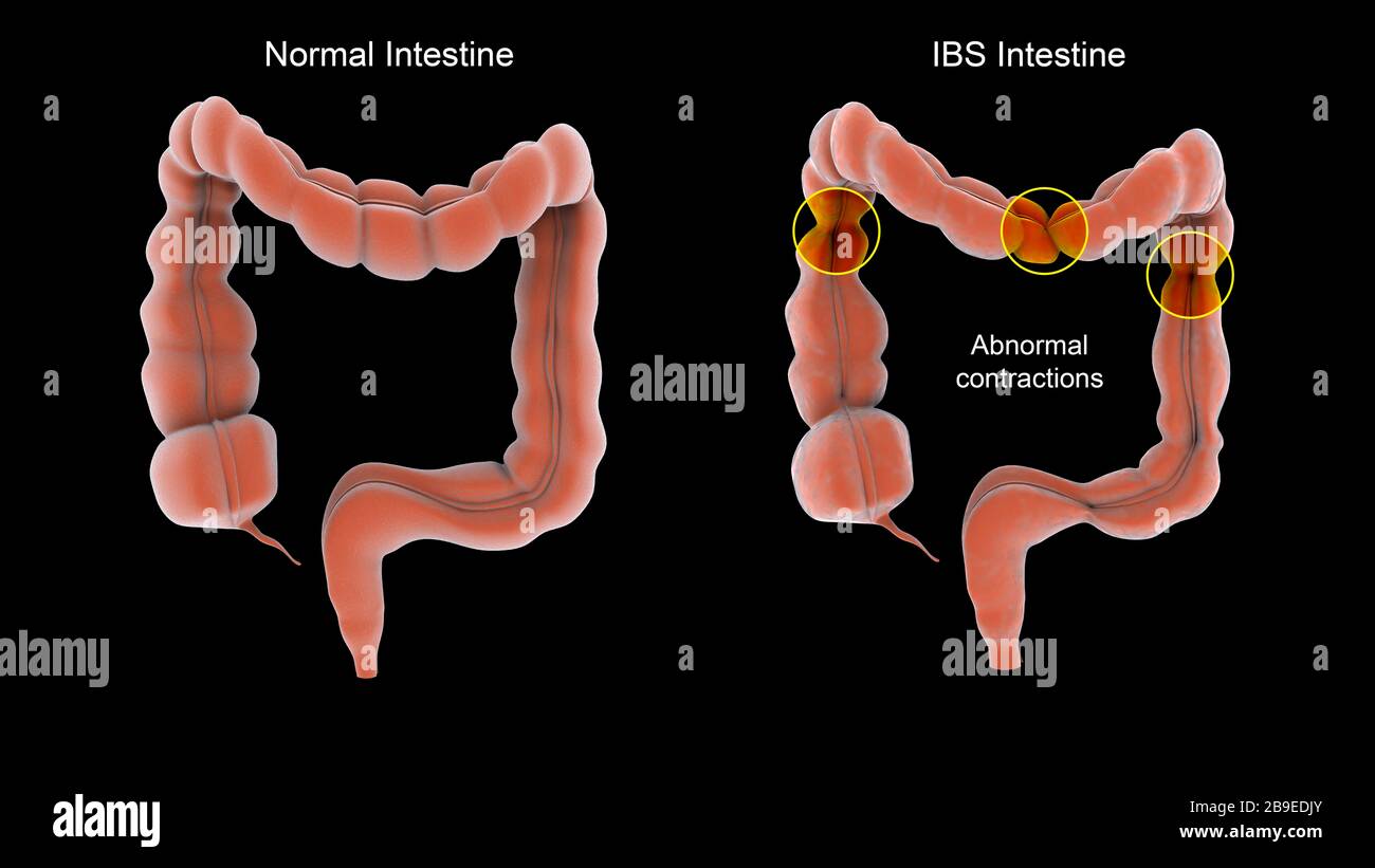 Intestin irritable Banque de photographies et d'images à haute résolution -  Alamy