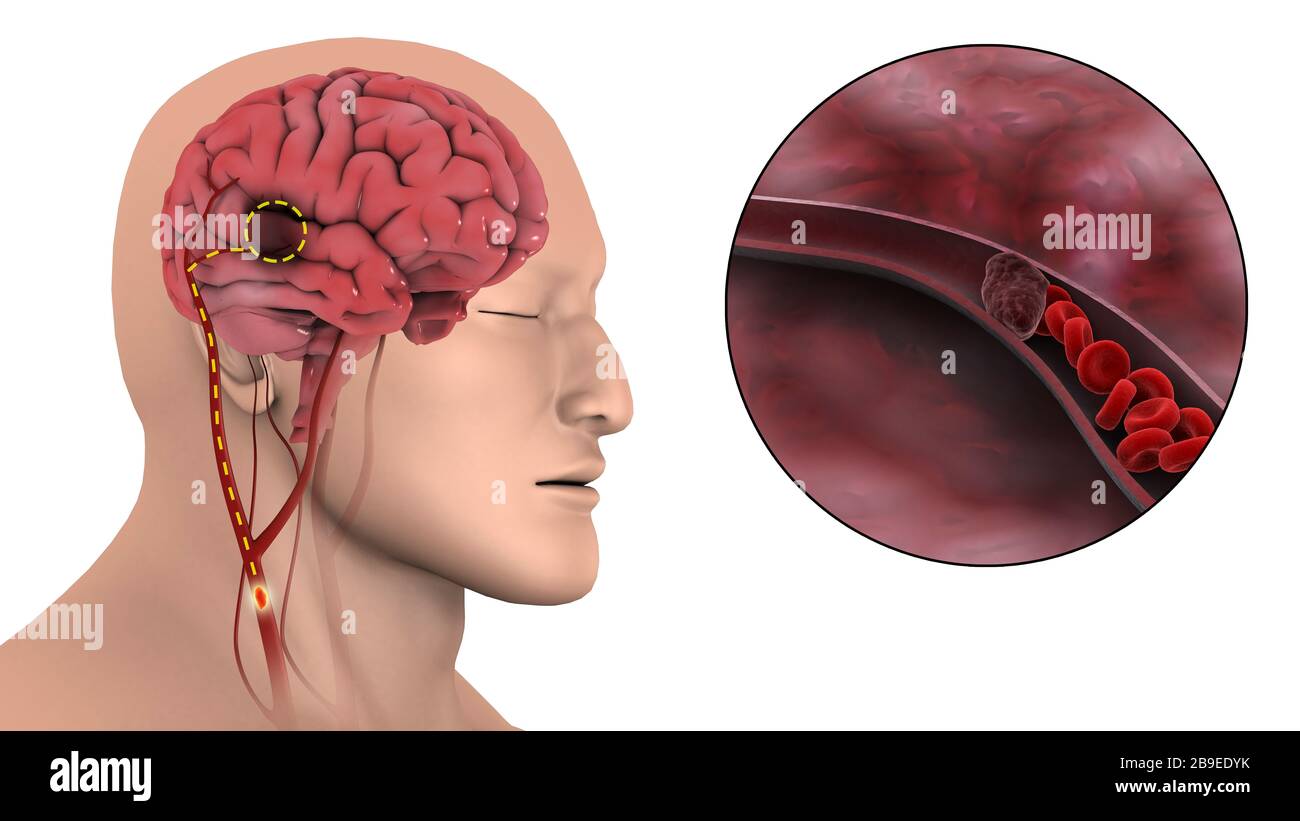 Illustration médicale d'un accident vasculaire cérébral ischémique. Banque D'Images