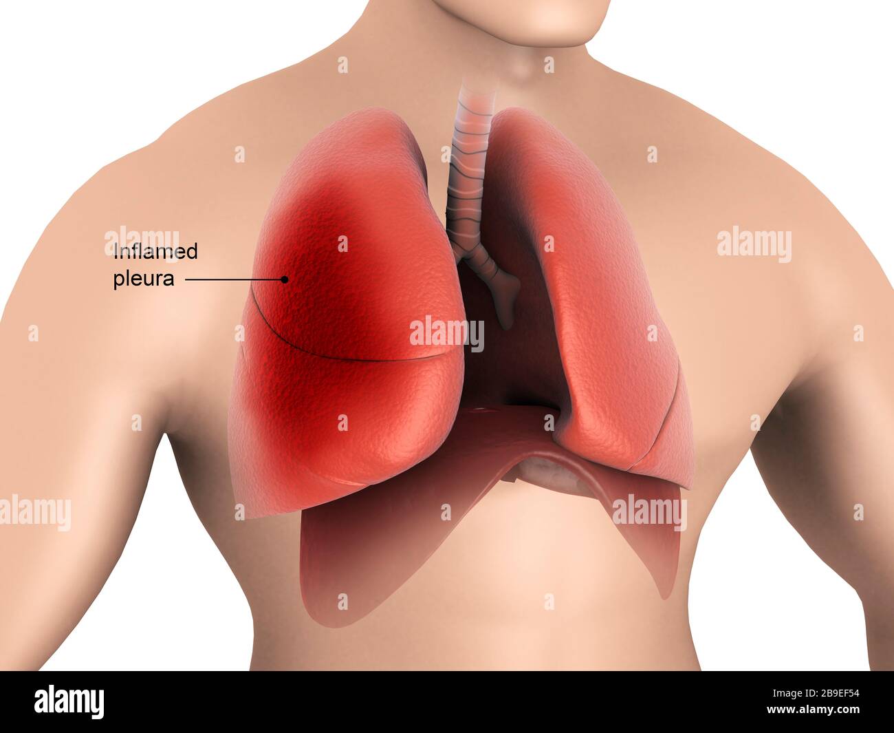 Illustration médicale montrant pleurésie dans les poumons humains. Banque D'Images