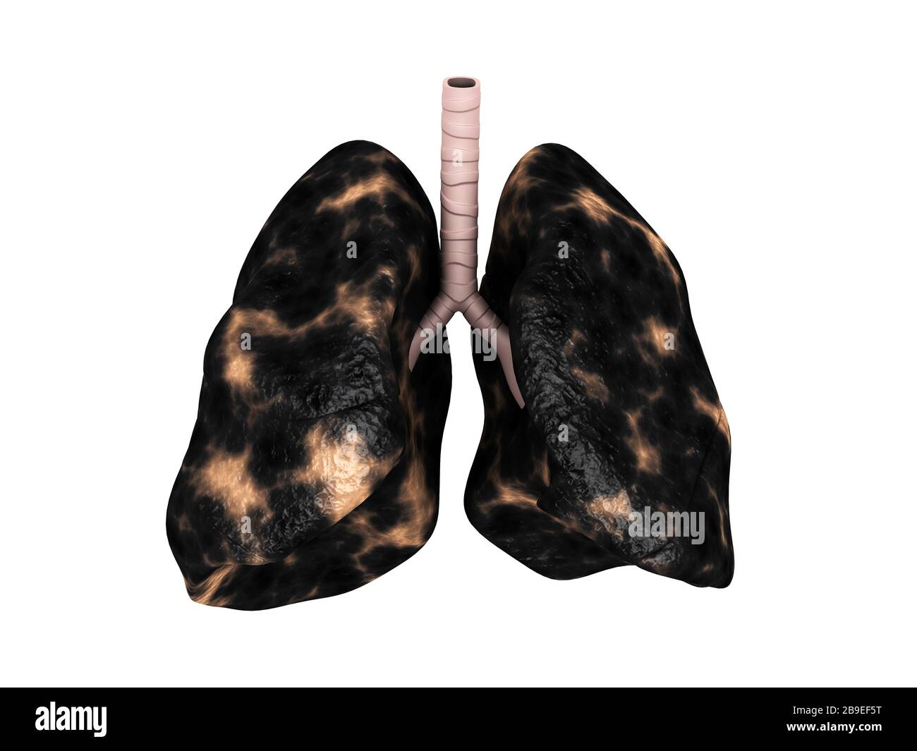 Illustration des poumons fumeur. Banque D'Images