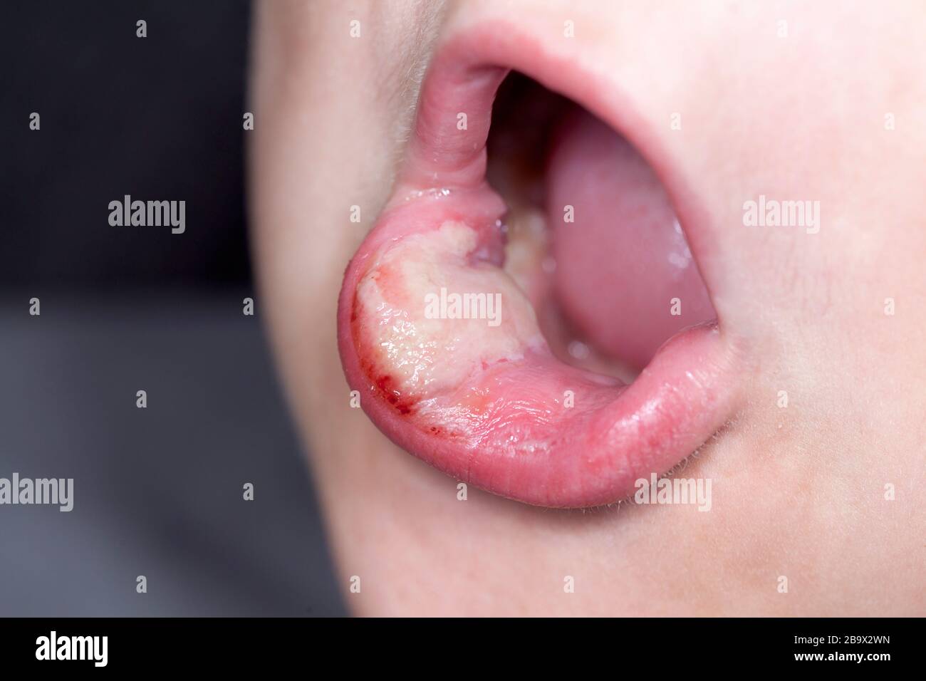 un garçon malade avec de grandes chasues sur ses lèvres Banque D'Images un garçon malade avec de grandes chasues sur ses lèvres Banque D'Images