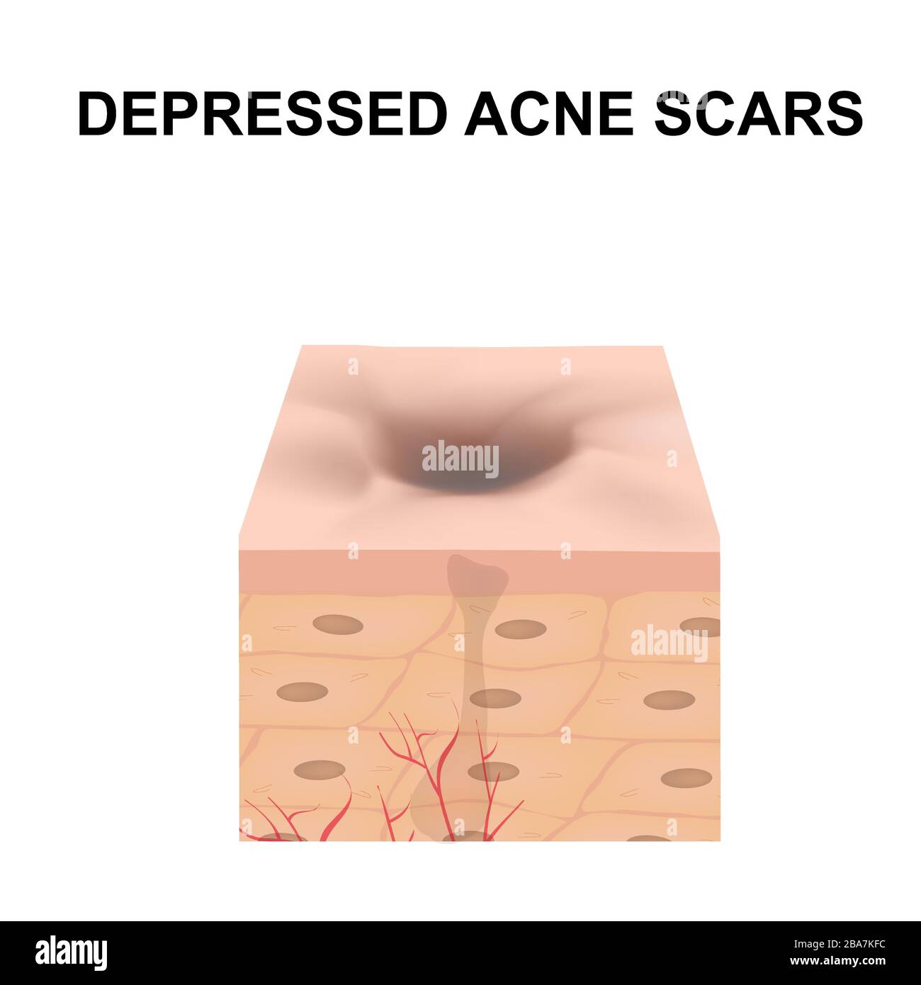 Cicatrices atrophiques. La cicatrice d'acné. La structure anatomique de la peau avec l'acné. Vector illustration sur fond isolé. Illustration de Vecteur