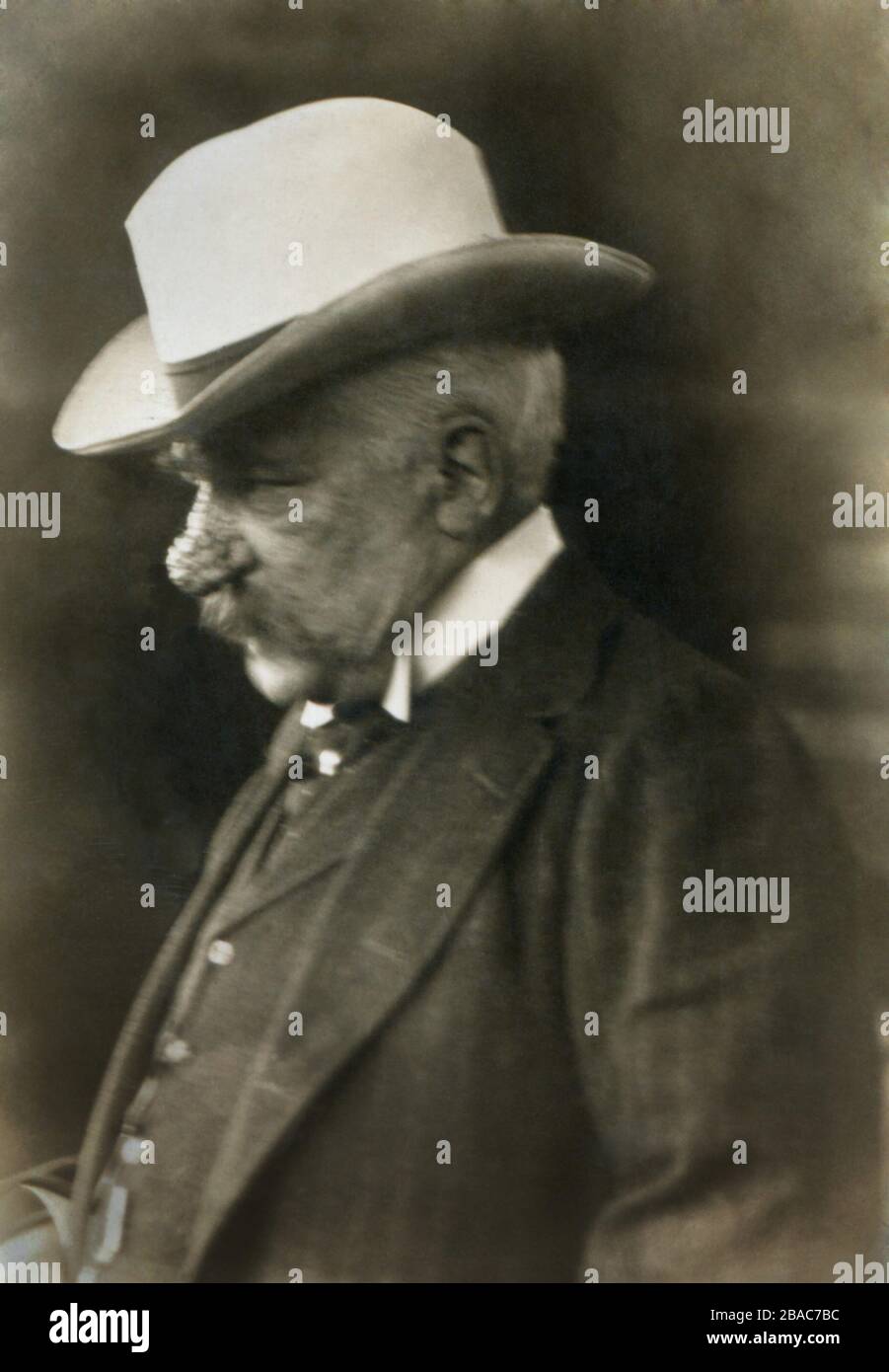 John Pierpont Morgan dans la photo de nouvelles candiées, c. 1900-13. La  photo de profil montre son nez affligé. Il souffrait de létat de la peau,  la rosacée, aggravée par le rhinophyma (