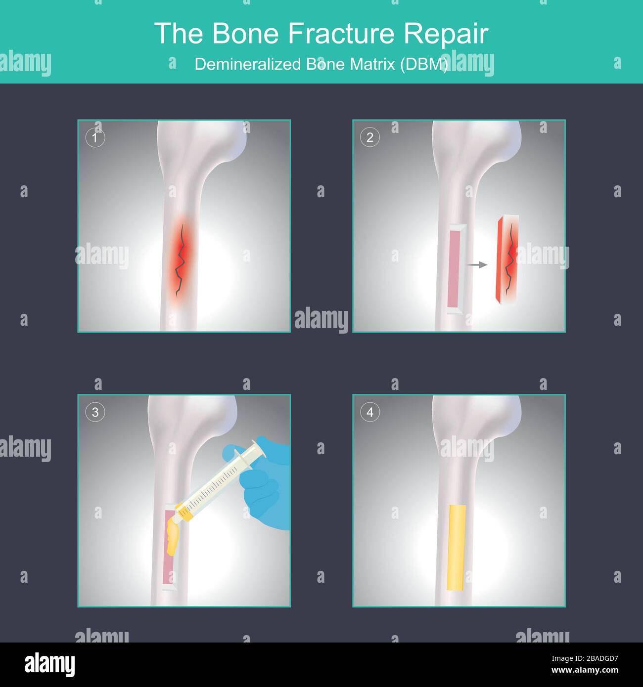La réparation de fracture osseuse. Exemple d'utilisation de matériaux spécialisés pour la chirurgie de réparation de fracture osseuse. Illustration de Vecteur