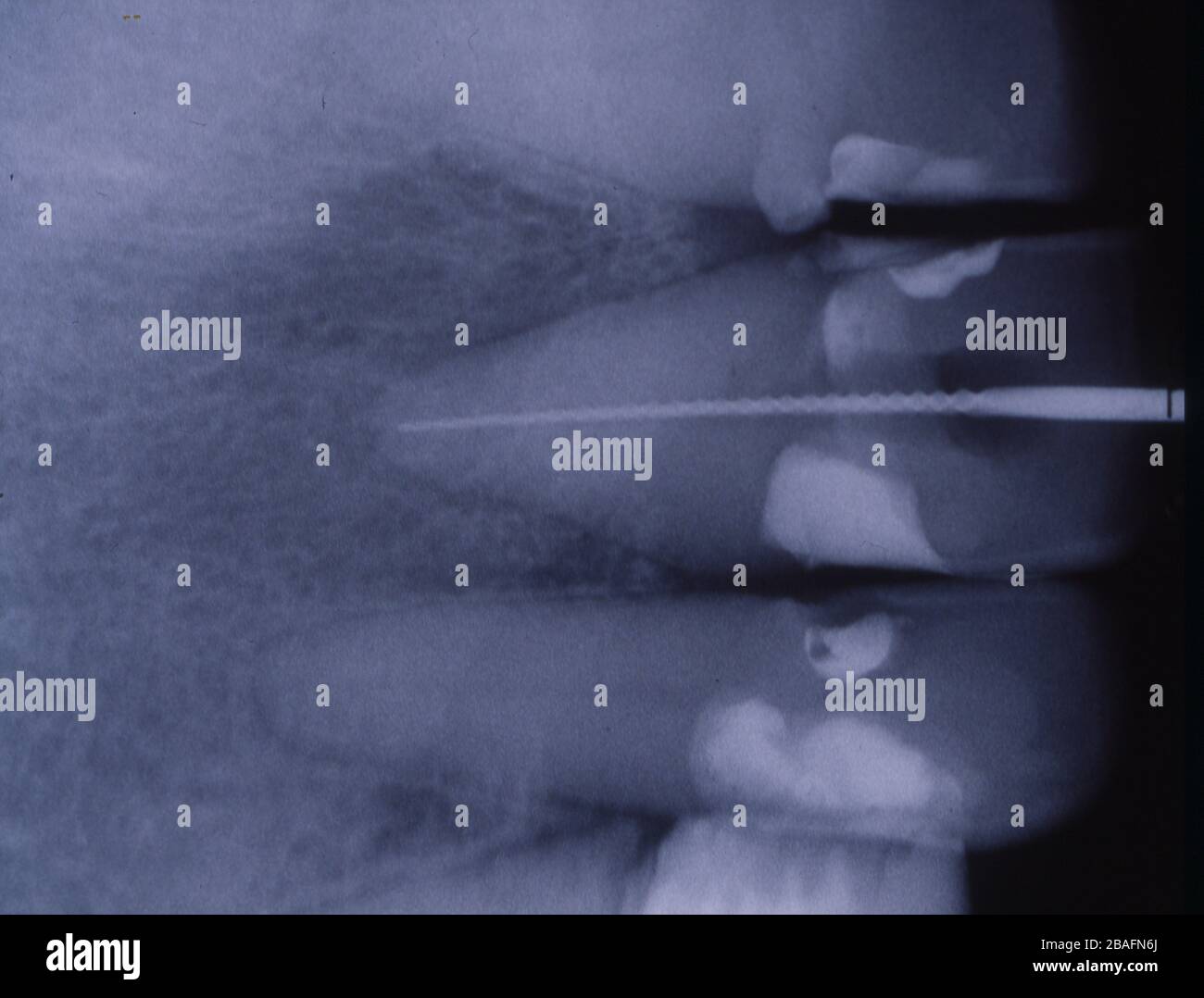 Image radiographique des dents avec garnitures et ponts Banque D'Images
