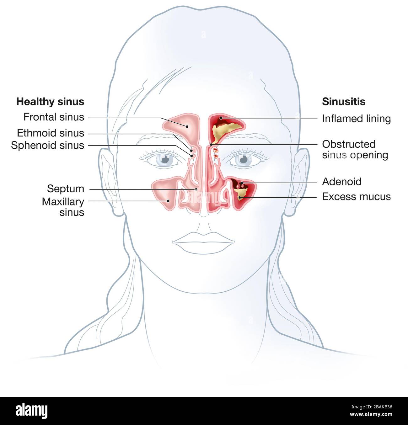 Illustration montrant un sinus sain et une sinusite avec une doublure enflammée, une ouverture de sinus obstruée, un énoïde et un excès de mucus Banque D'Images