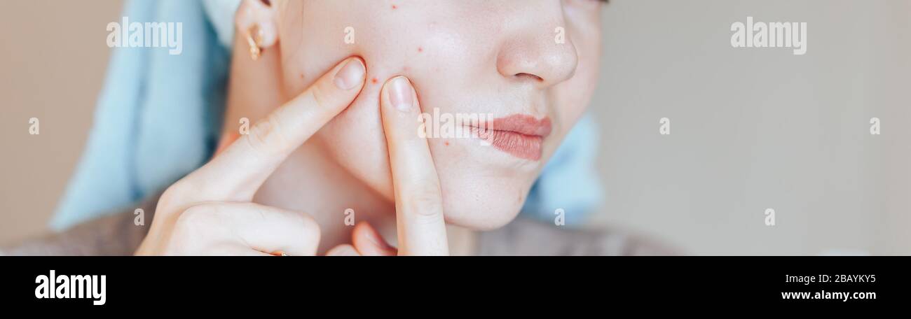 Une adolescente l'appuie sur ses boutons, en enlevant le pémple de son visage. Femme concept de soins de la peau des photos de la fille laid problème de peau sur fond beige. Banque D'Images