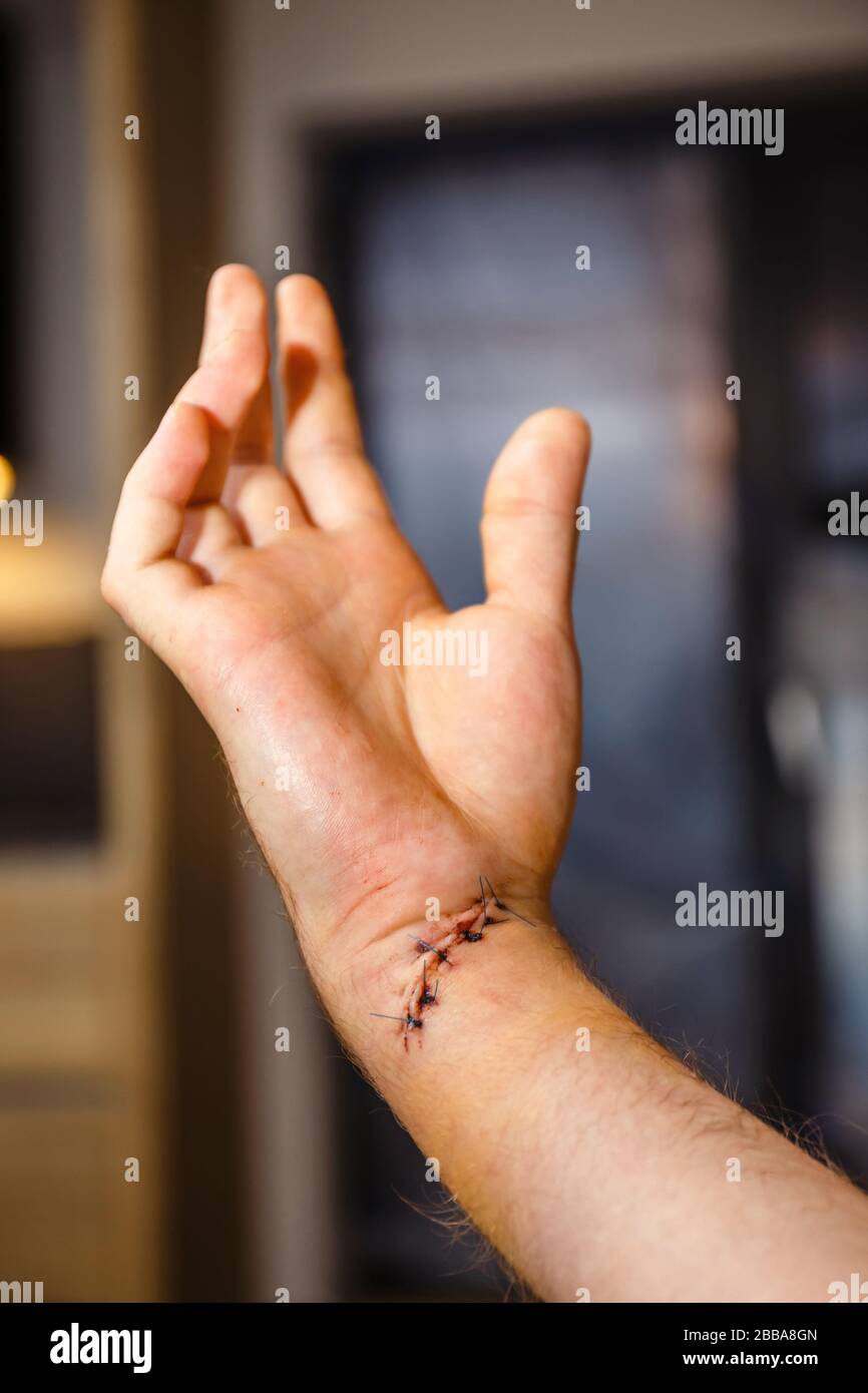 cicatrice fraîche sur le poignet après la chirurgie du tendon et du nerf Banque D'Images