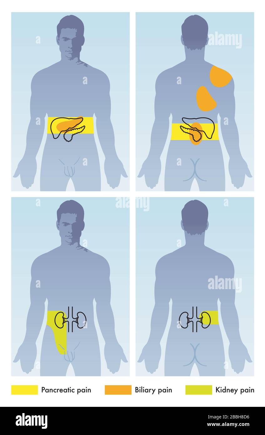 Illustration médicale de la figure masculine avec douleurs pancréatiques, biliaires et rénales localisées. Illustration de Vecteur