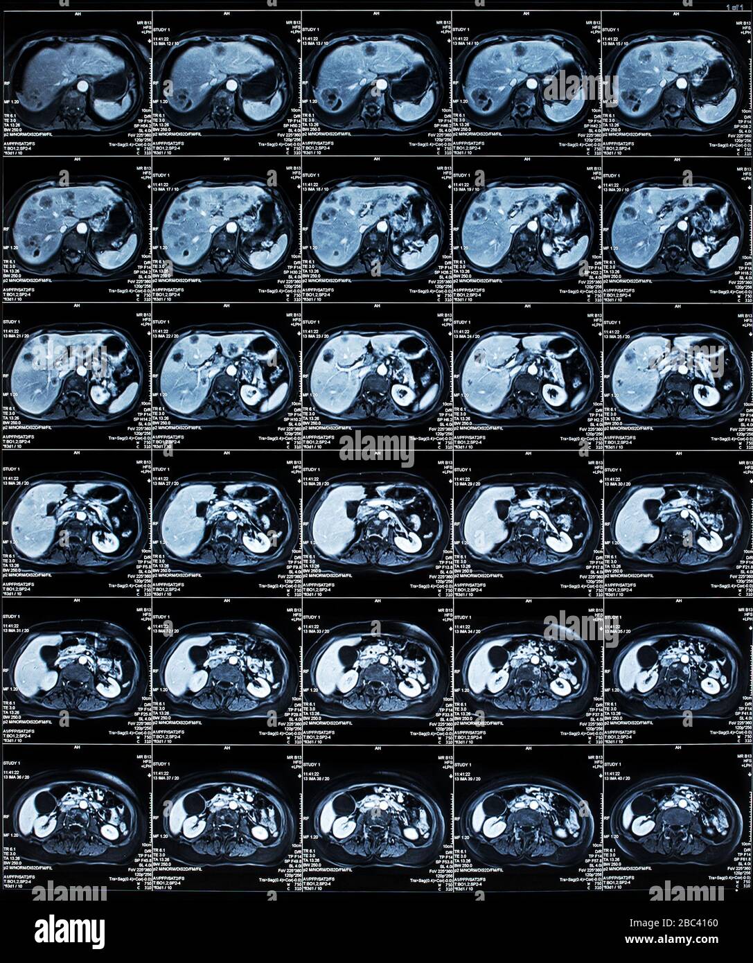 Examen IRM des organes de l'abdomen humain Banque D'Images