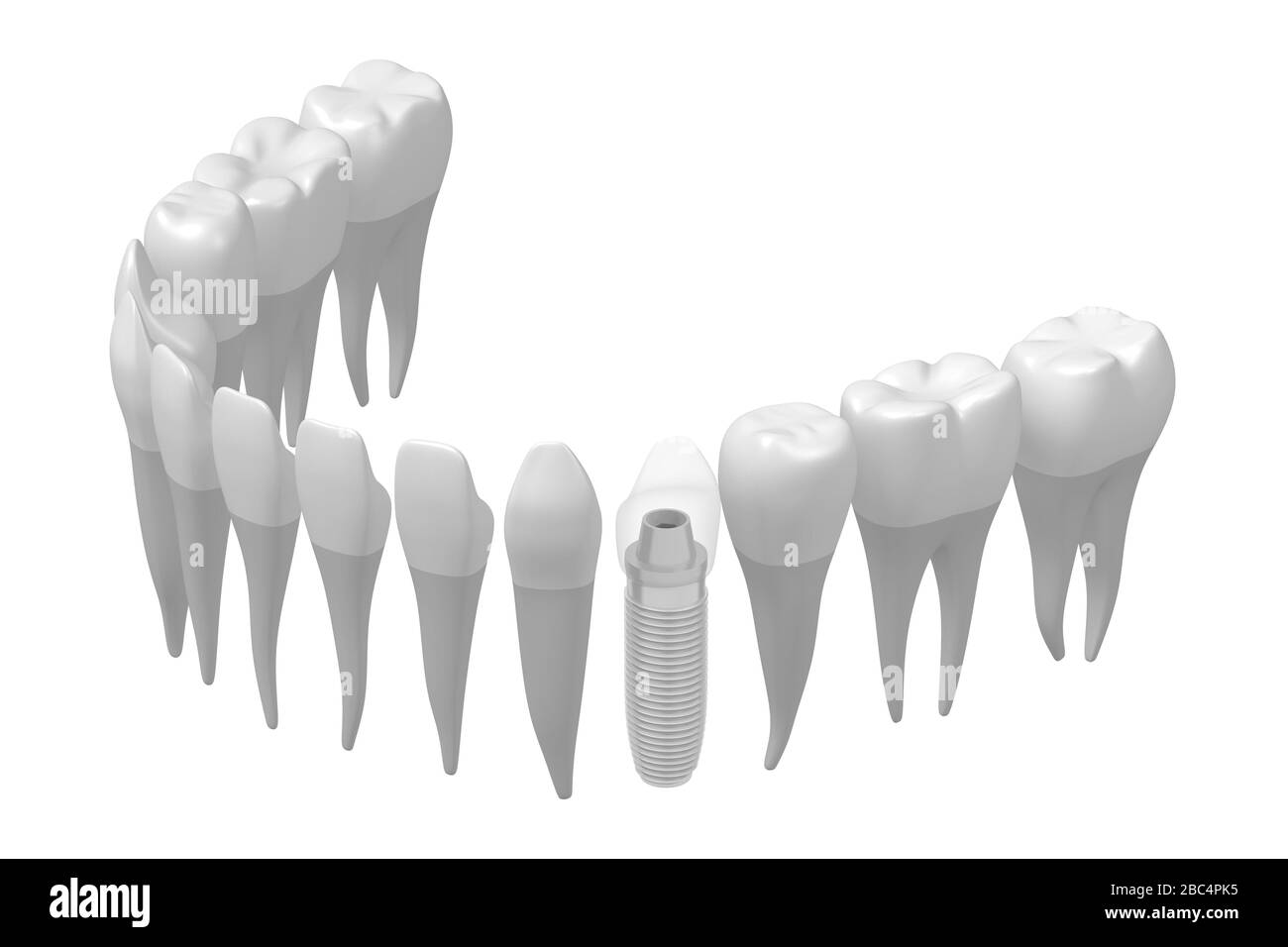 Implant dentaire/implant dentaire Banque D'Images