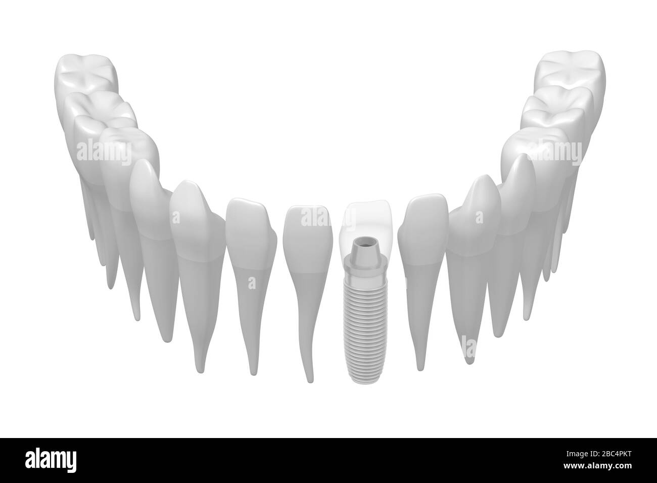 Implant dentaire/implant dentaire Banque D'Images