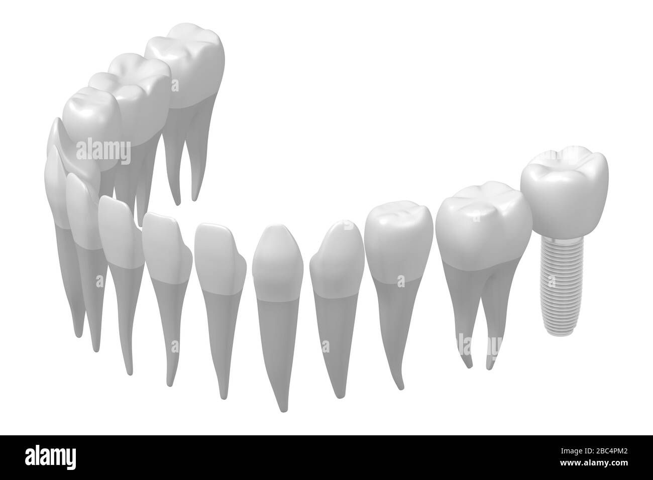 Implant dentaire/implant dentaire Banque D'Images