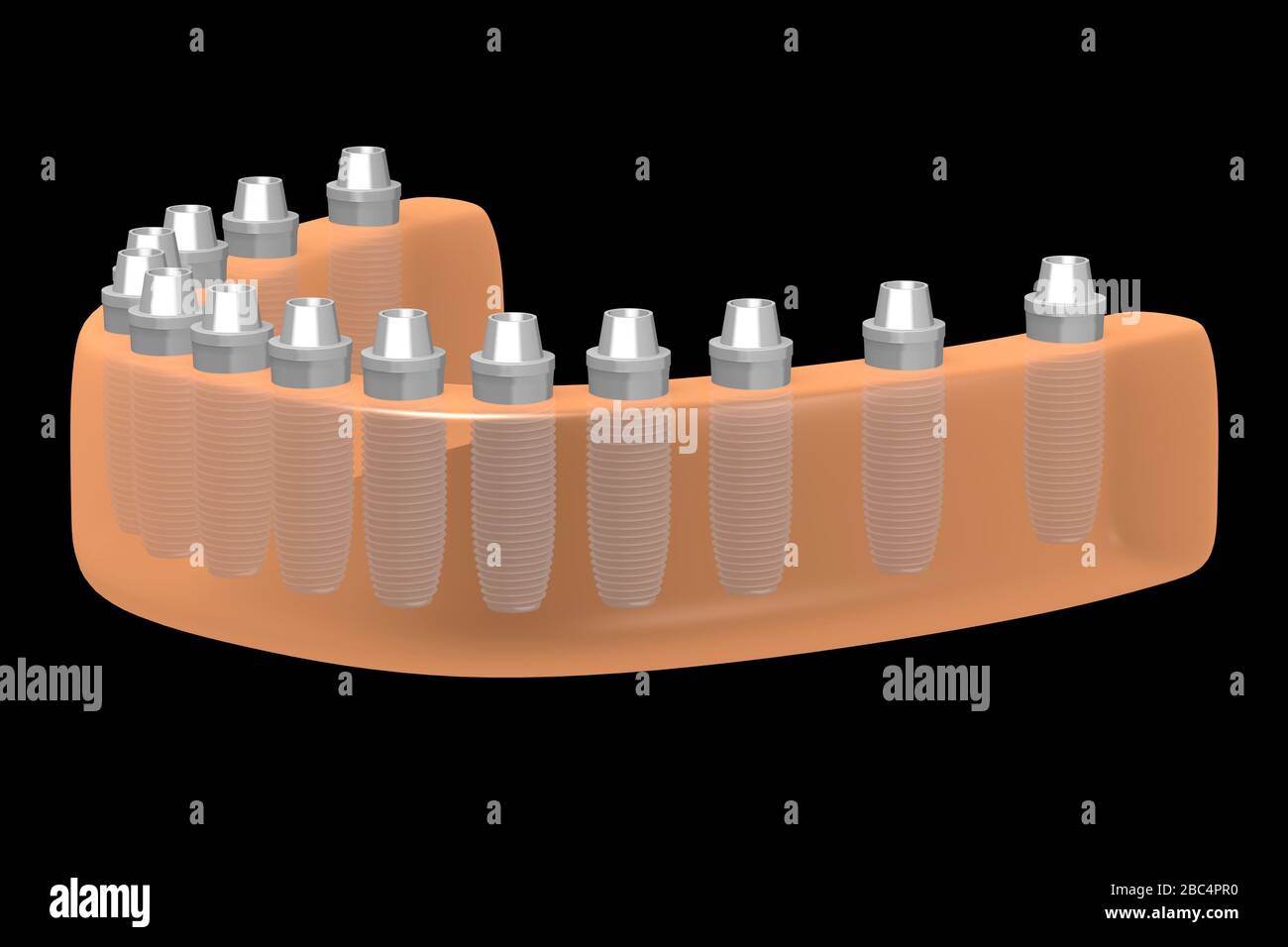 Implants dentaires/implants dentaires Banque D'Images