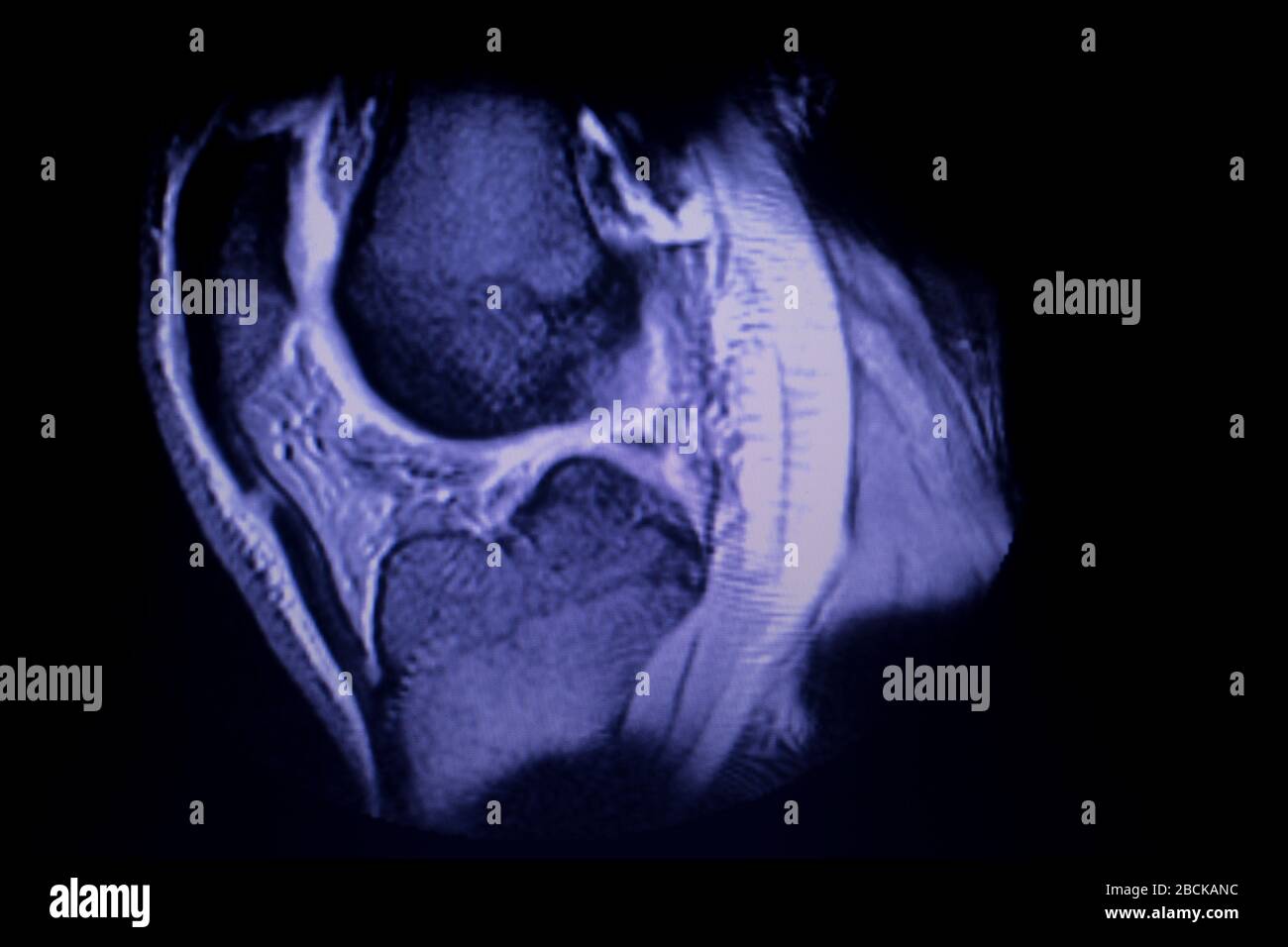L'imagerie par résonance magnétique IRM GENOU corne postérieure du ...