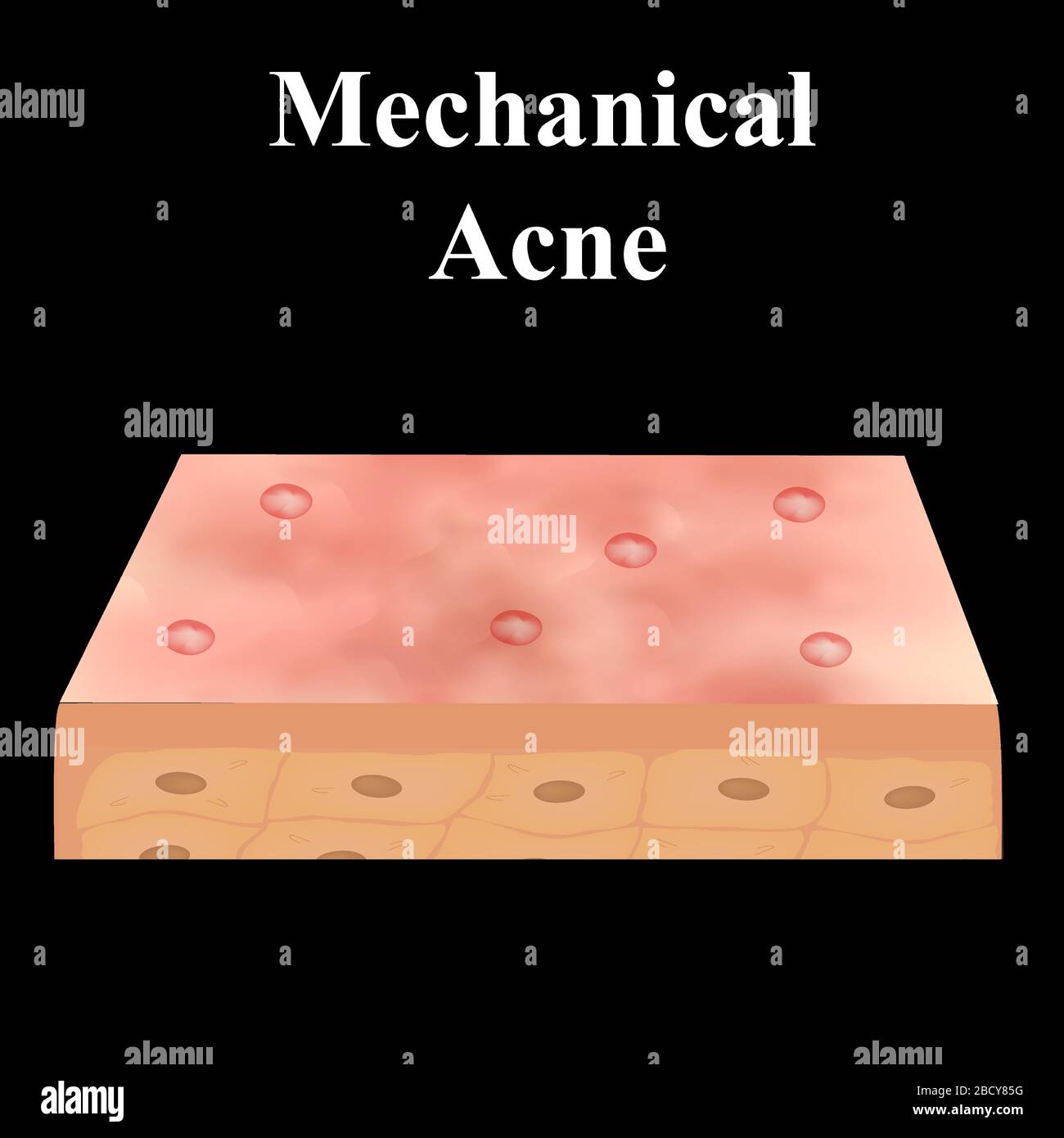 Acné de kyste. Acné sur la peau d'un kyste. Maladies dermatologiques et ...
