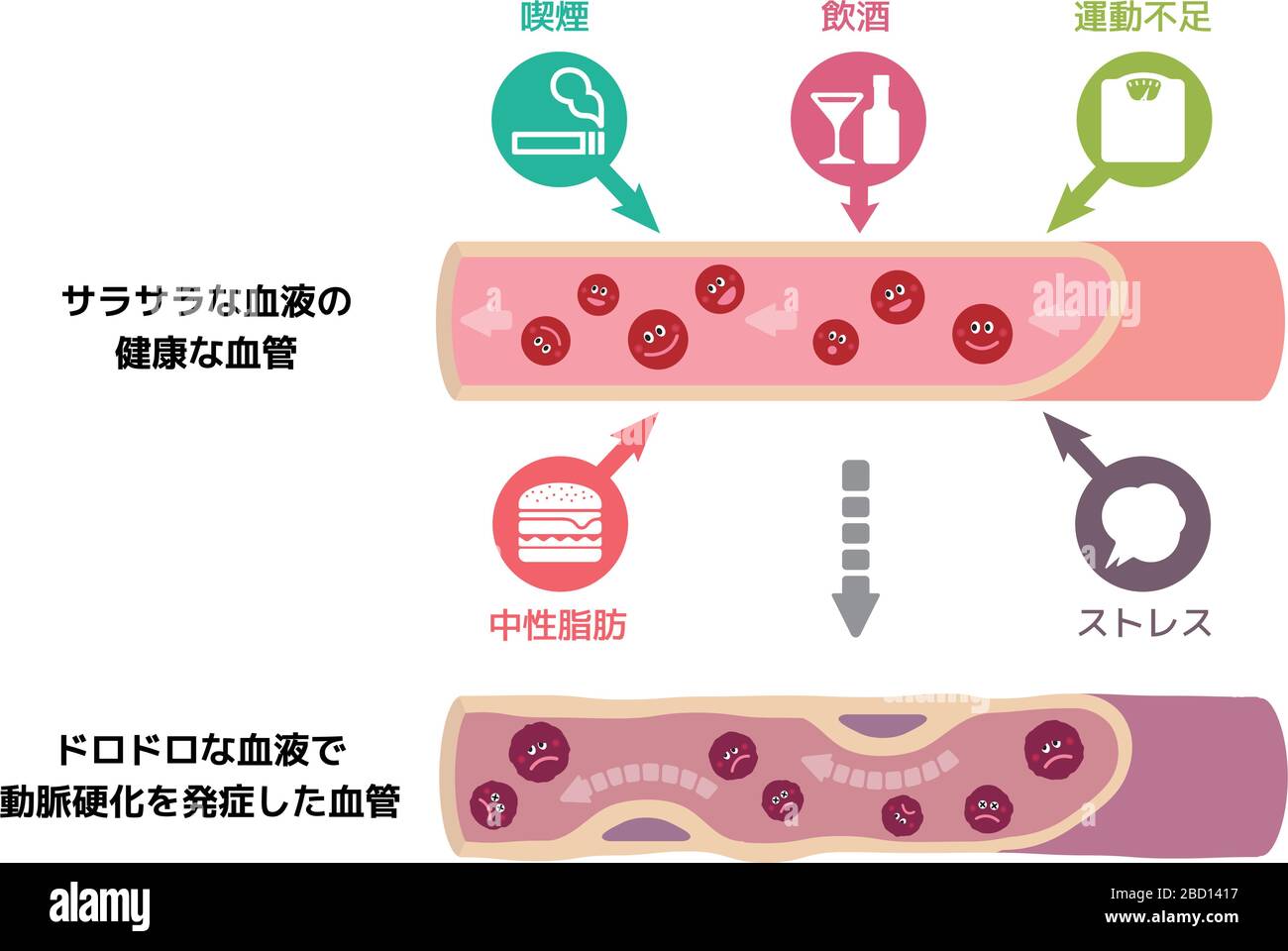 Illustration que le sang sain devient du sang boueux en raison de divers facteurs malsains, causant l'artériosclérose Illustration de Vecteur