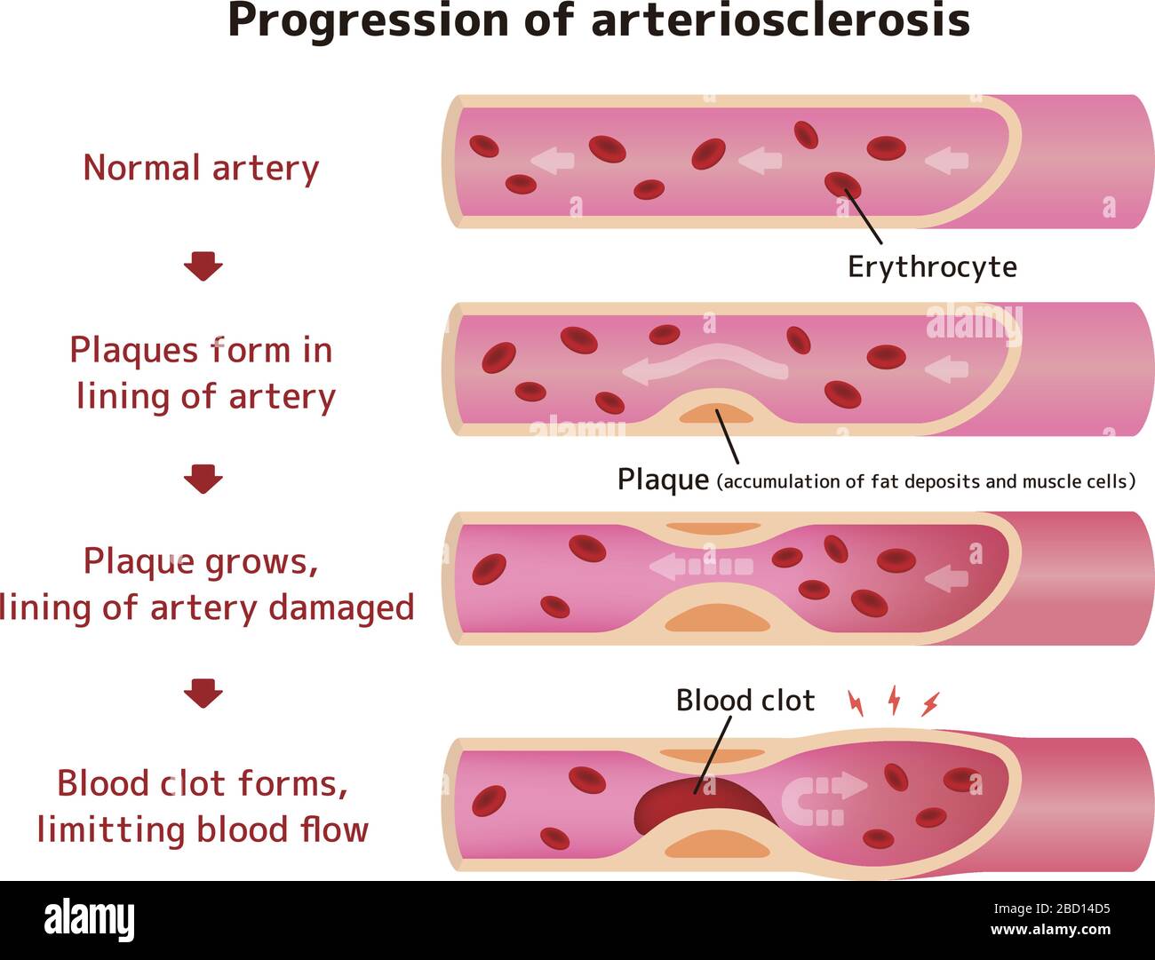 Progression de l'illustration de l'artériosclérose Illustration de Vecteur