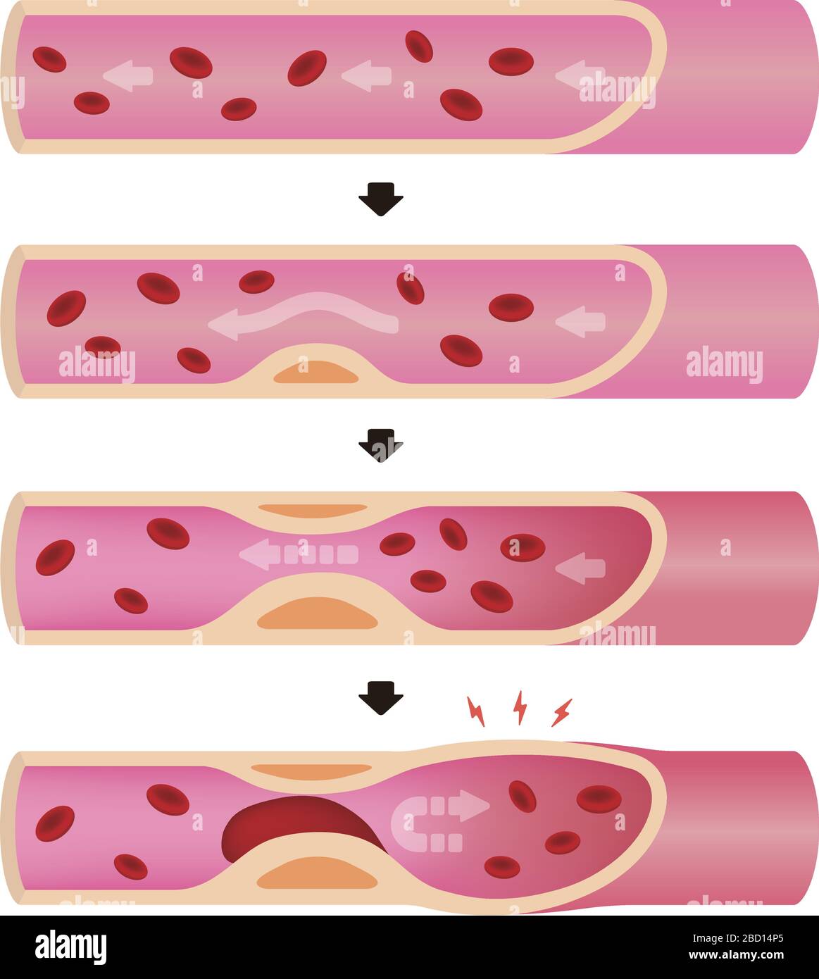 Progression de l'illustration de l'artériosclérose Illustration de Vecteur