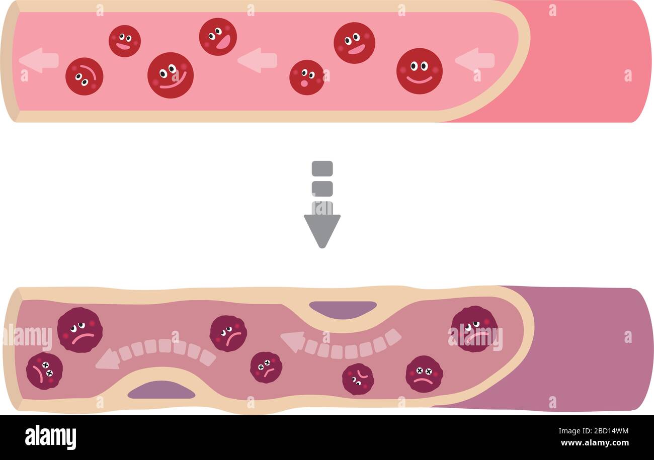 Illustration que le sang sain devient du sang boueux en raison de divers facteurs malsains, causant l'artériosclérose Illustration de Vecteur