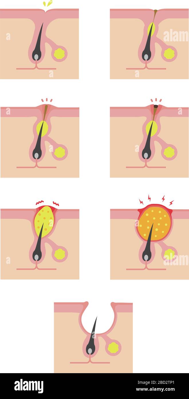 Types d'illustrations d'acné (soins de la peau) Illustration de Vecteur