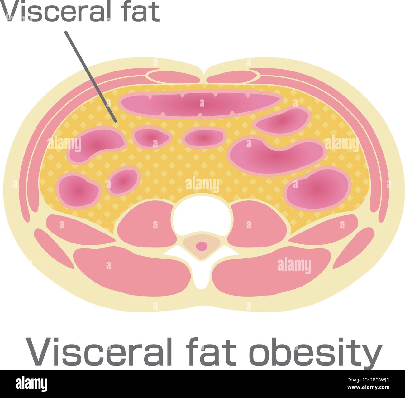 Type d'illustration de l'obésité . Vue en coupe abdominale (graisse viscérale ). Illustration de Vecteur