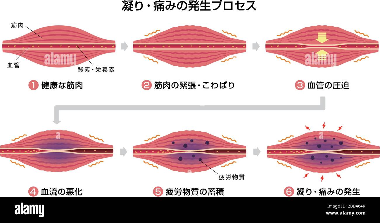 Processus de rigidité musculaire et illustration de la douleur ( 6 étapes ) Illustration de Vecteur