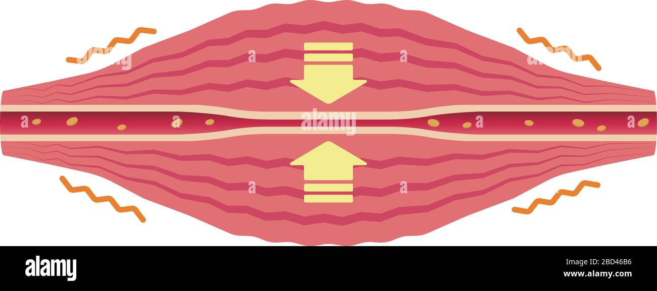 Vaisseau sanguin comprimé. Illustration plate du muscle et du vaisseau. Illustration de Vecteur