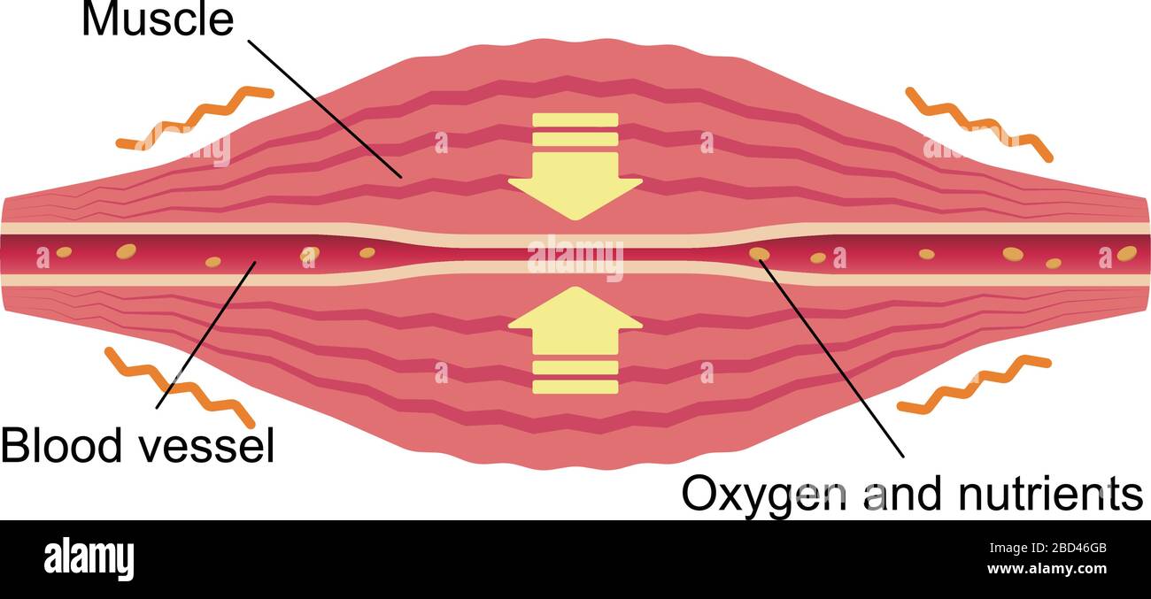 Vaisseau sanguin comprimé. Illustration plate du muscle et du vaisseau. Illustration de Vecteur