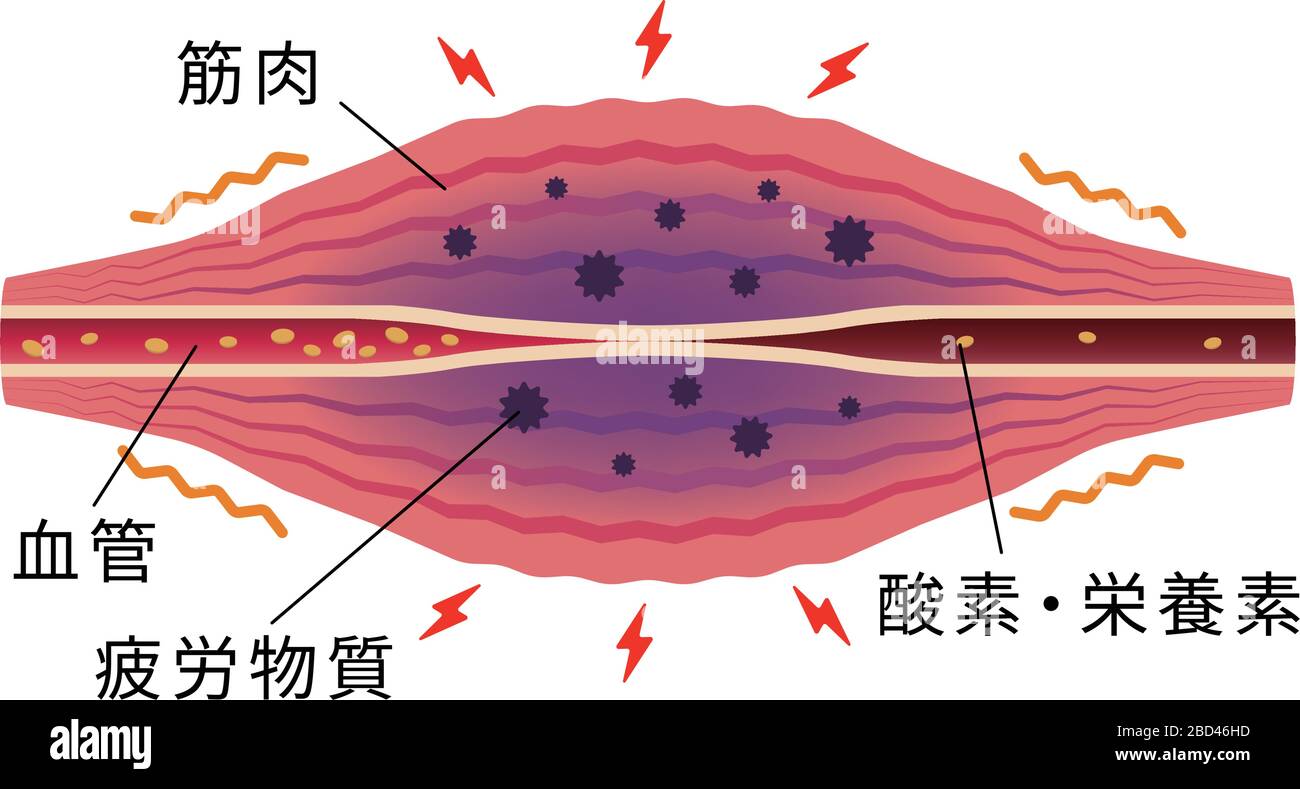Stuffness et douleur se produisent . Illustration plate du muscle et du vaisseau. Illustration de Vecteur