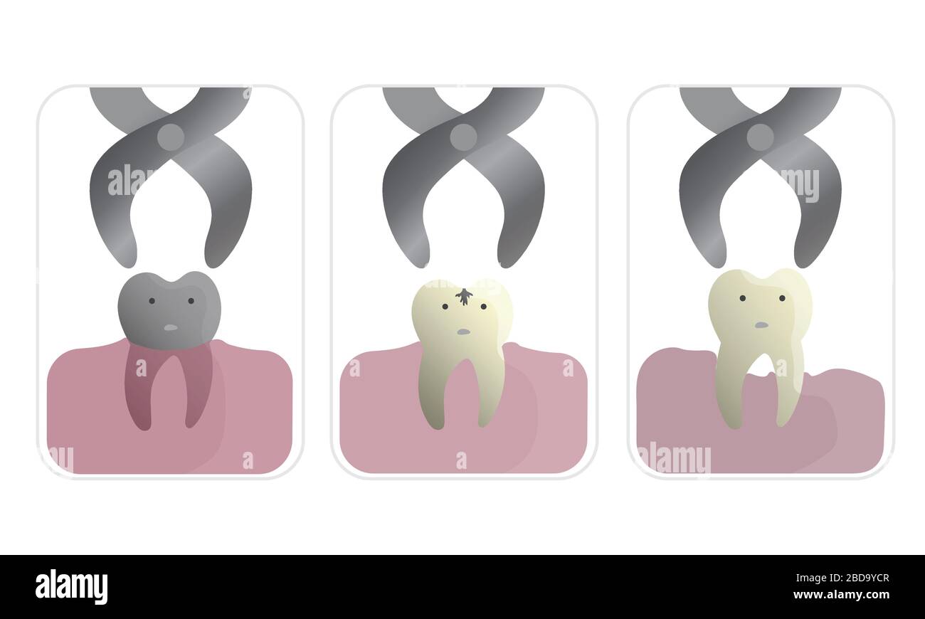 Retrait des dents par des forceps d'extraction dans différents types de maladies Illustration de Vecteur
