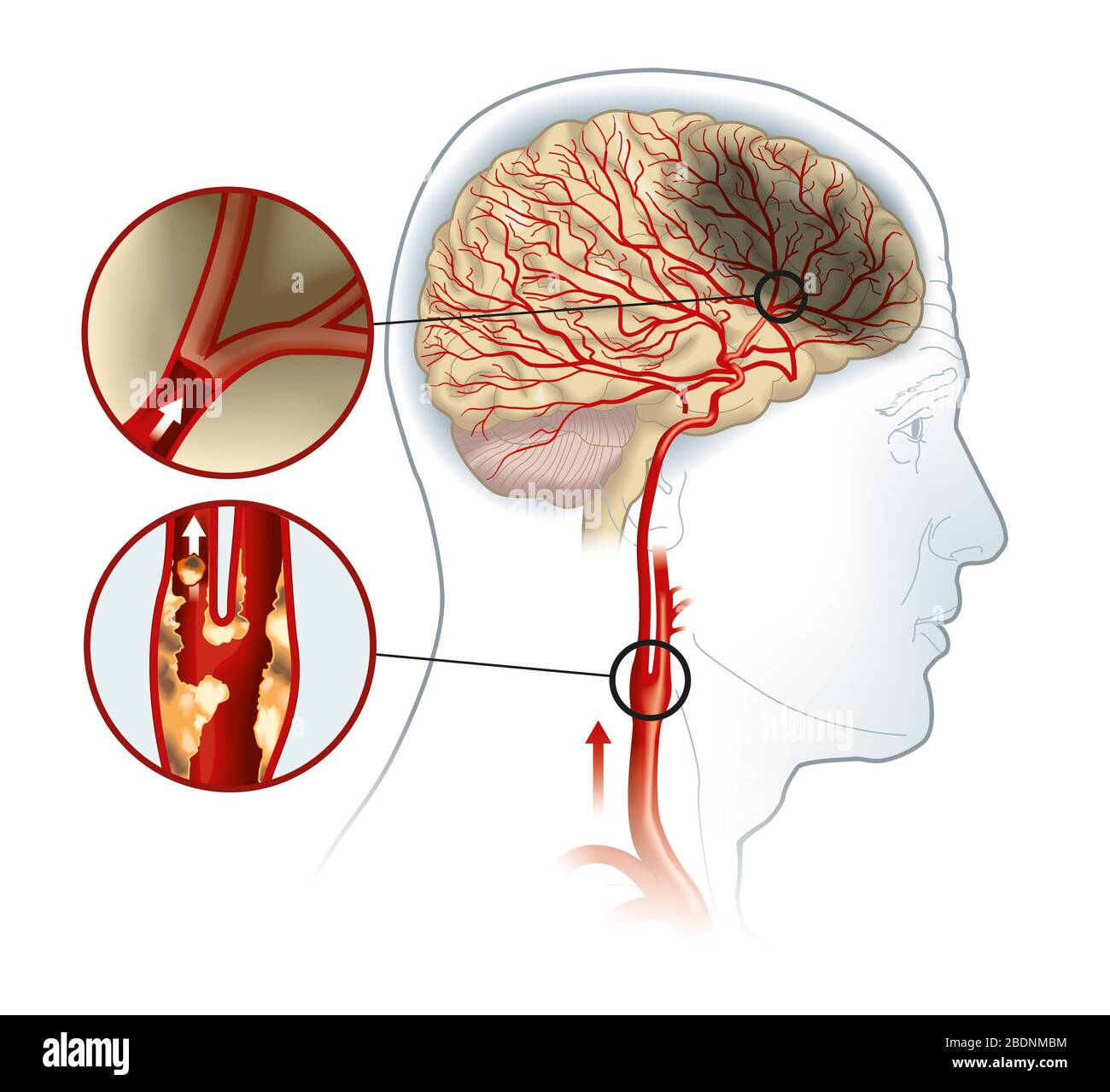 Illustration montrant la plaque de l'artère carotide, une caillot sanguin  se brisant et bloquant le flux sanguin Photo Stock - Alamy