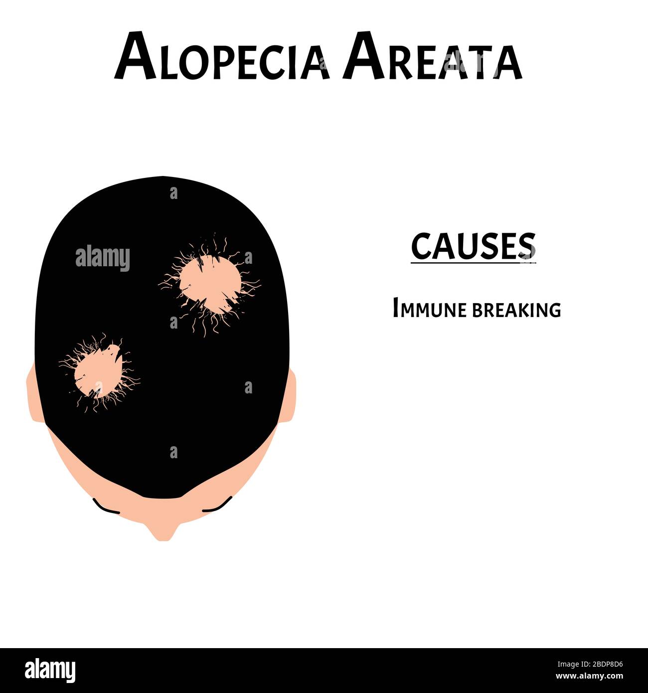 Alop cie Cheveux Calvitie Des Cheveux Sur La T te Causes D alopecia alop-cie-cheveux-calvitie-des-cheveux-sur-la-t-te-causes-d-alopecia