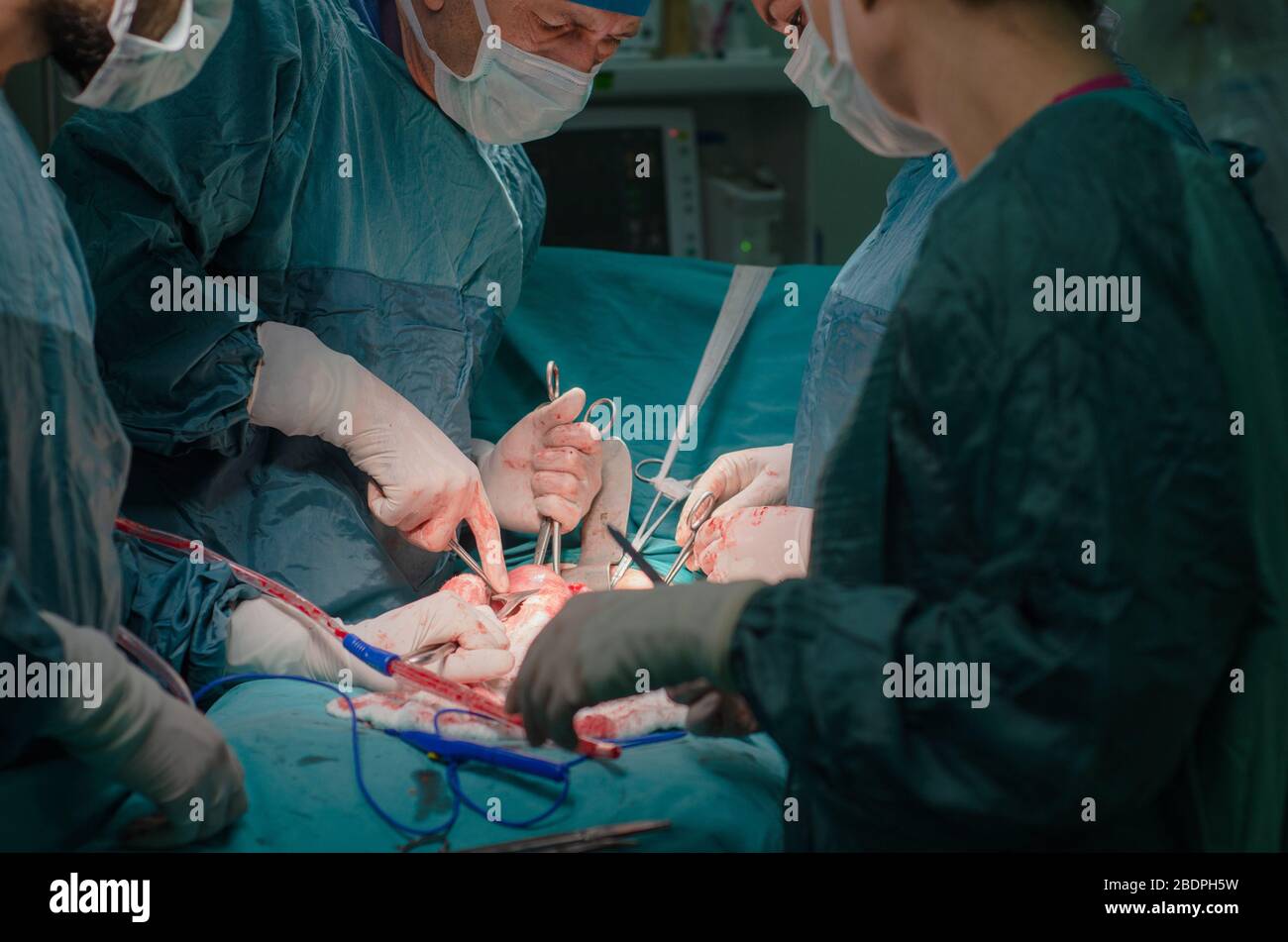 Utérus enlevé par chirurgien dans l'opération d'hystérectomie. Banque D'Images